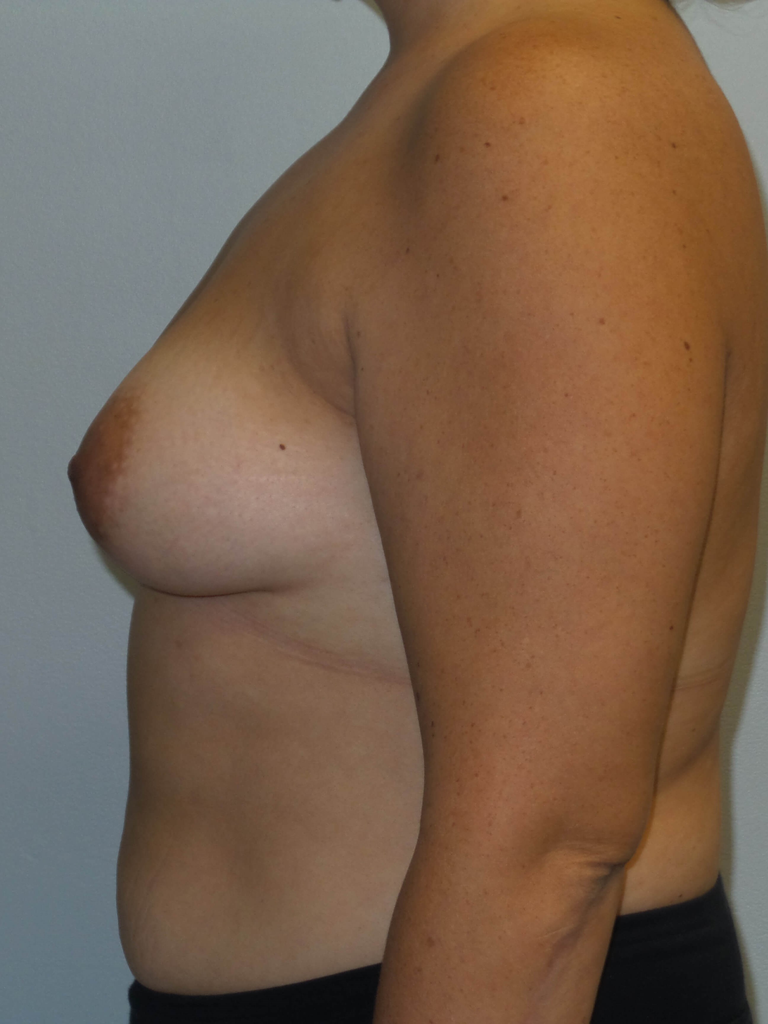 Westlake Woman Has Breast Aug Before