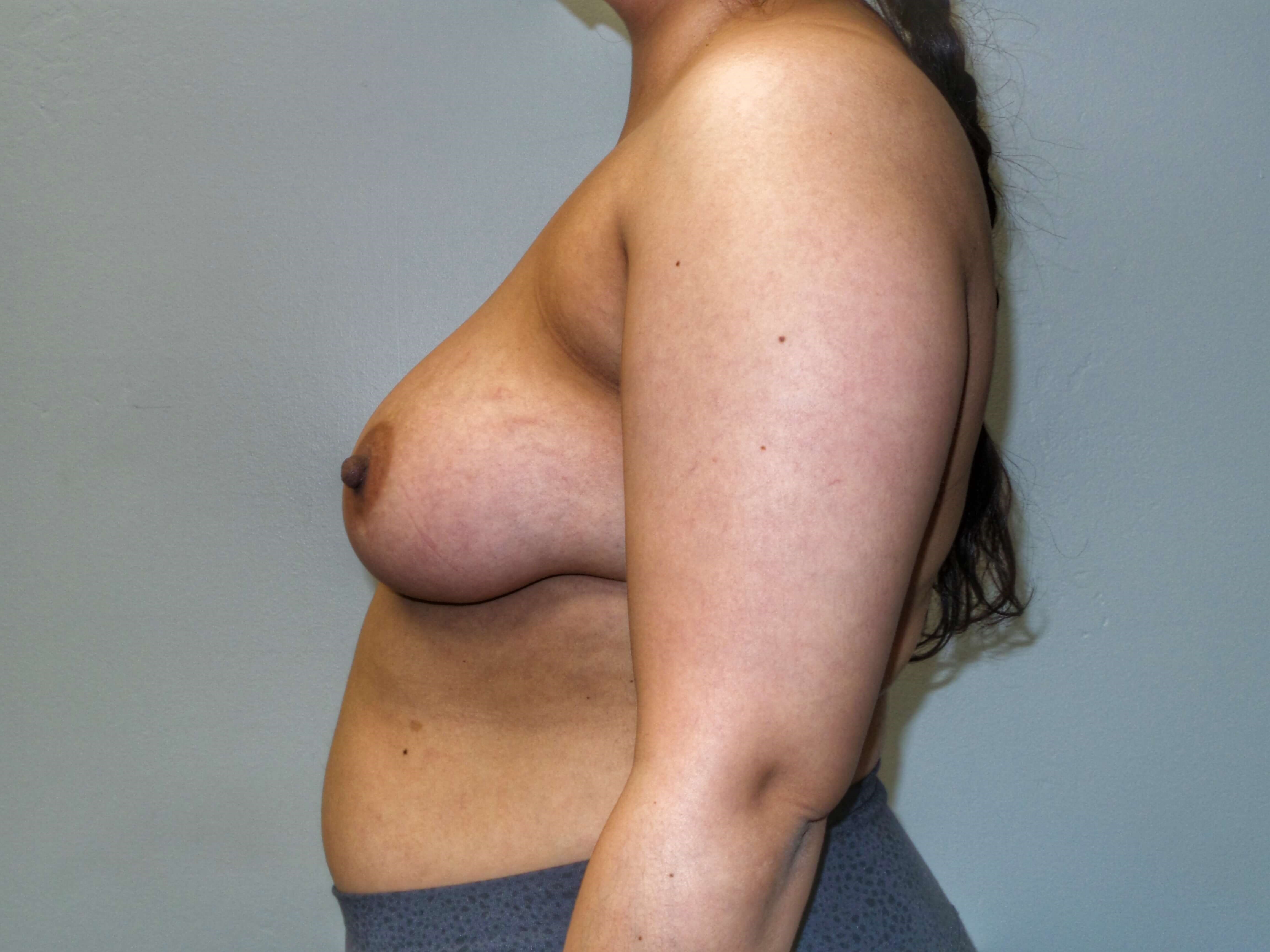 Woman has Breast Lift Before