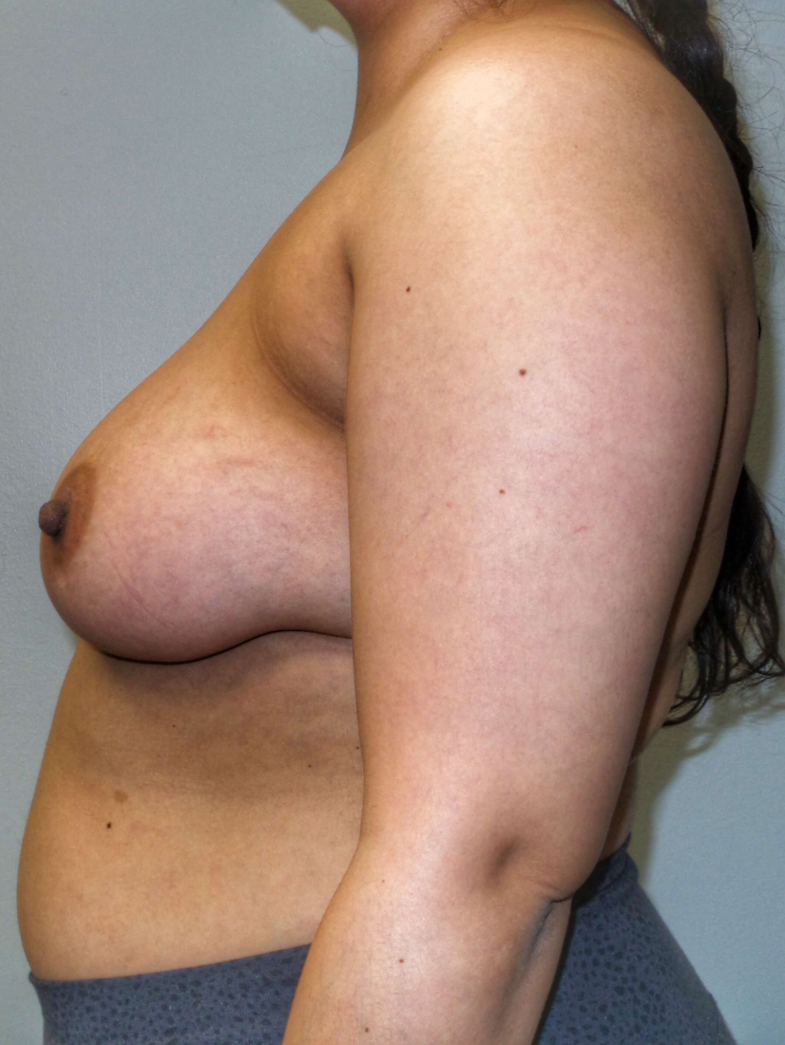 Woman has Breast Lift Before