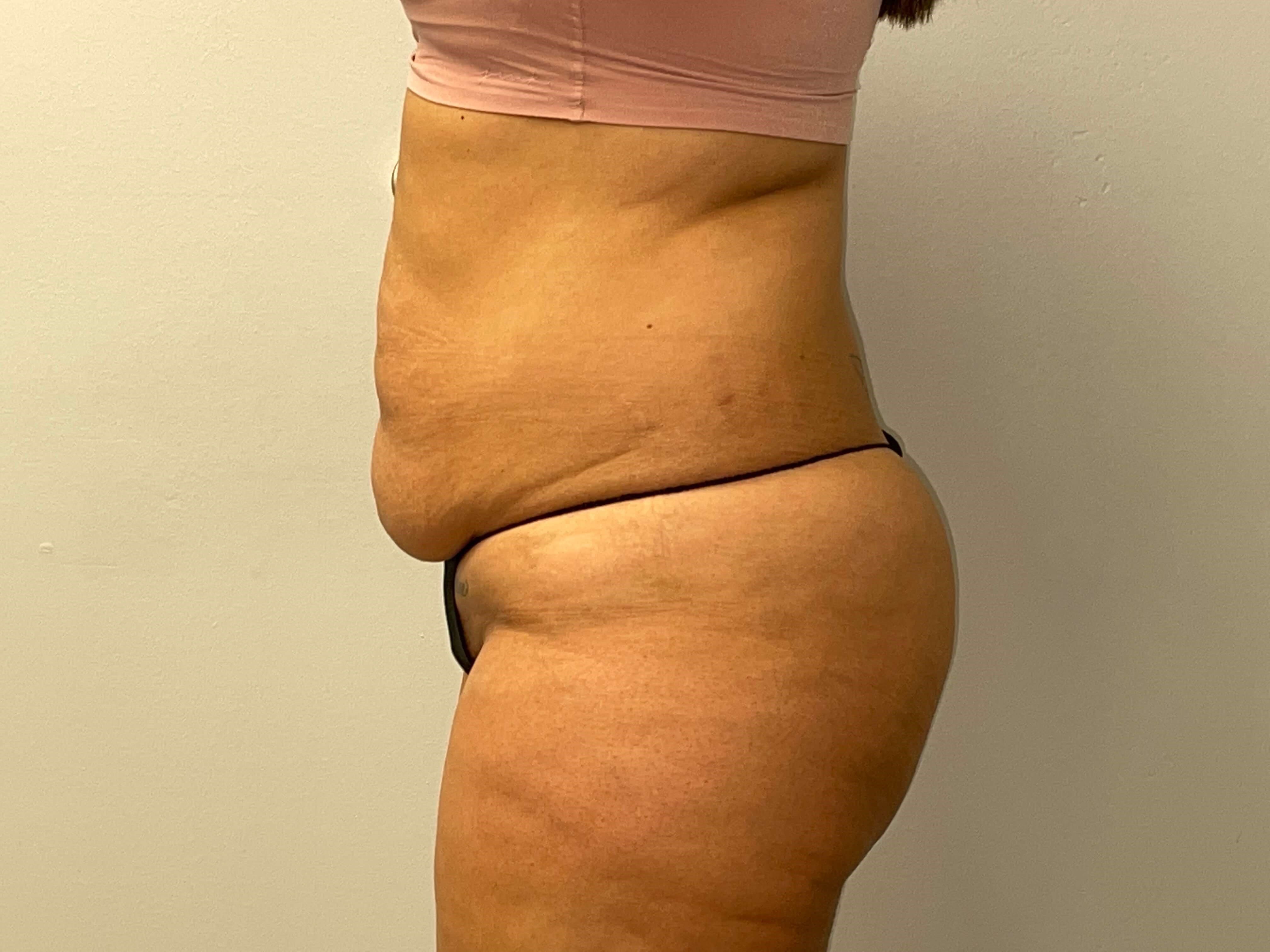 Woman Has Tummy Tuck Lipo Before