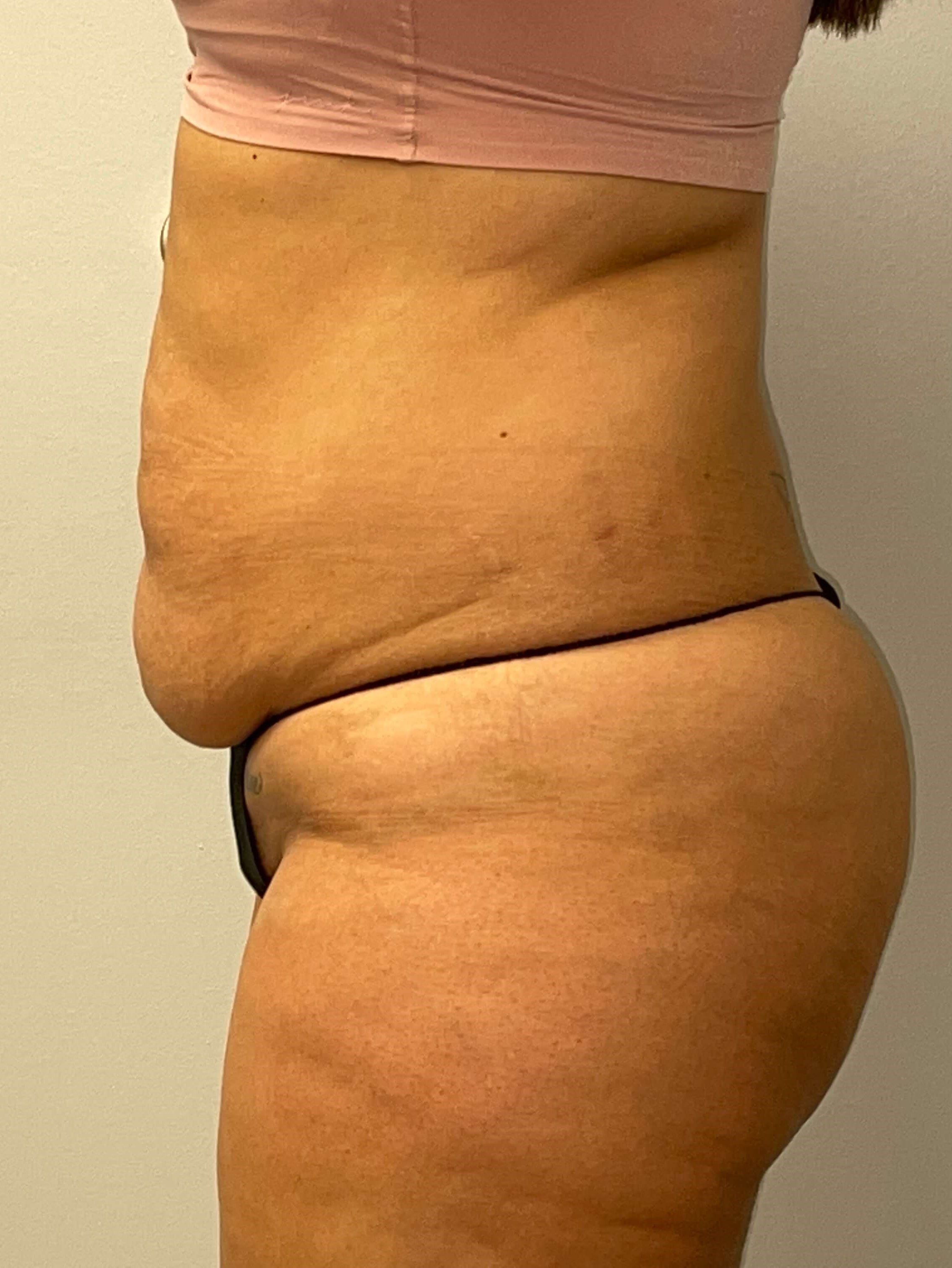 Woman Has Tummy Tuck Lipo Before