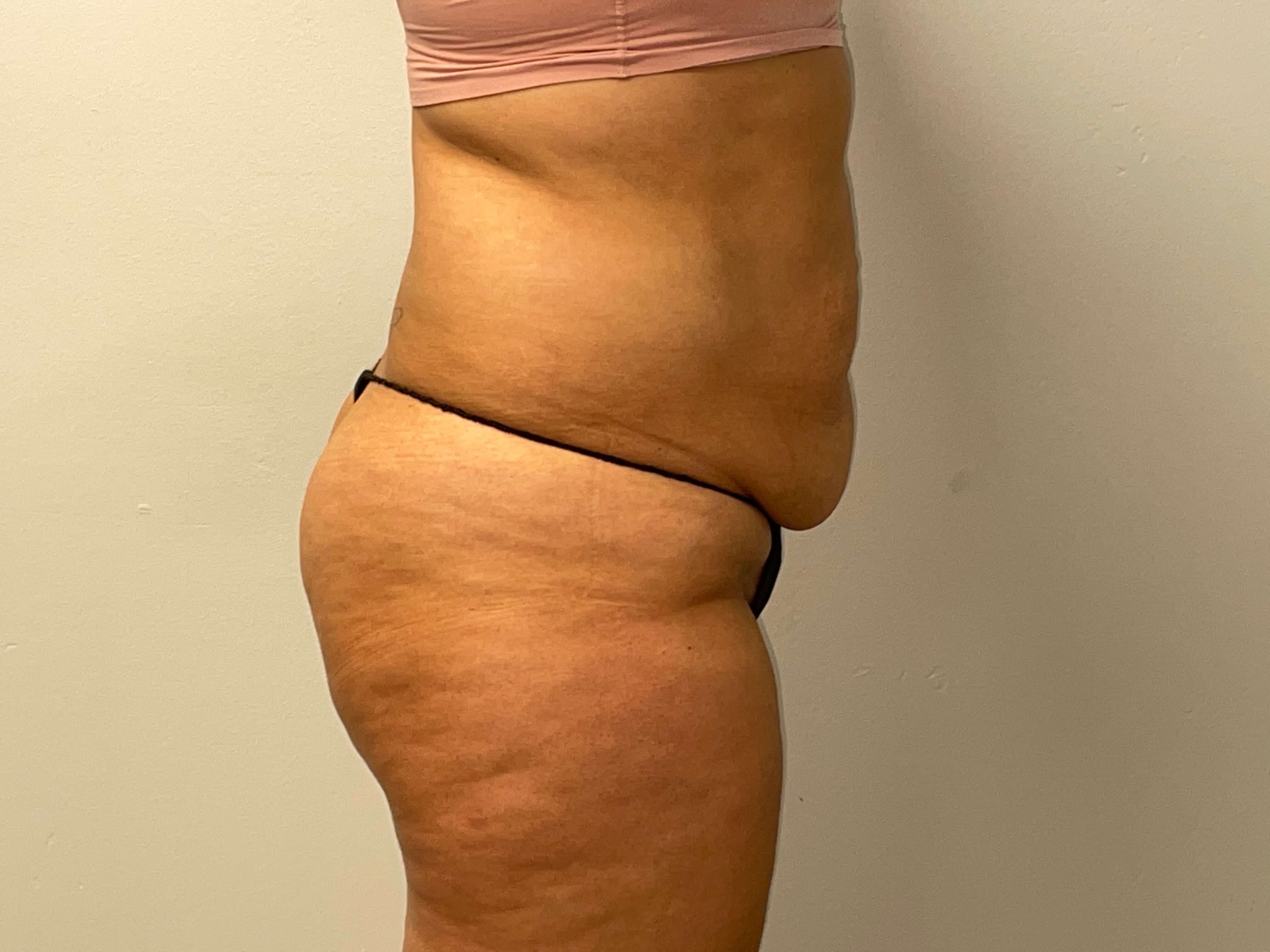Woman Has Tummy Tuck Lipo Before