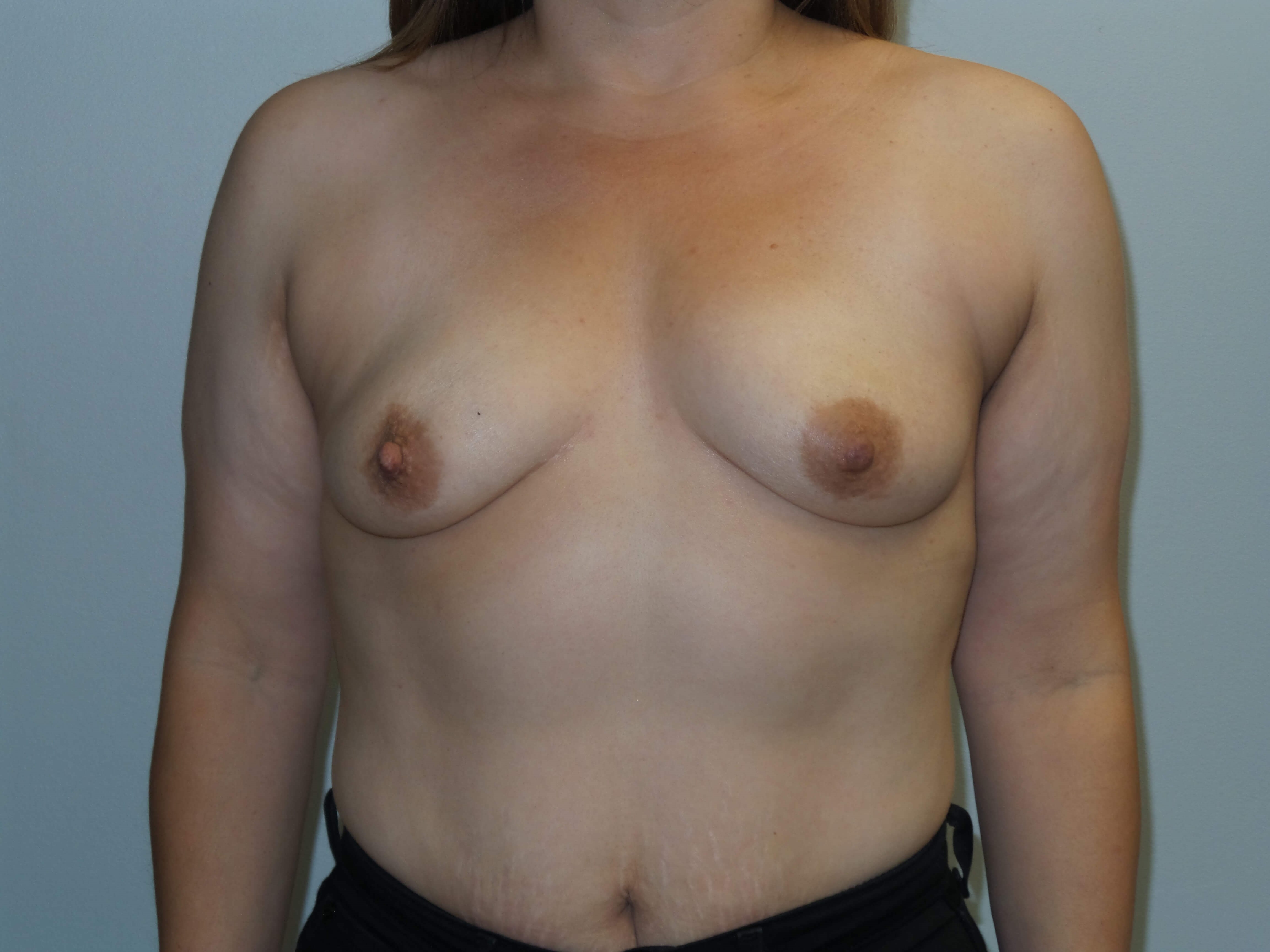 Westlake Woman Has Breast Aug Before
