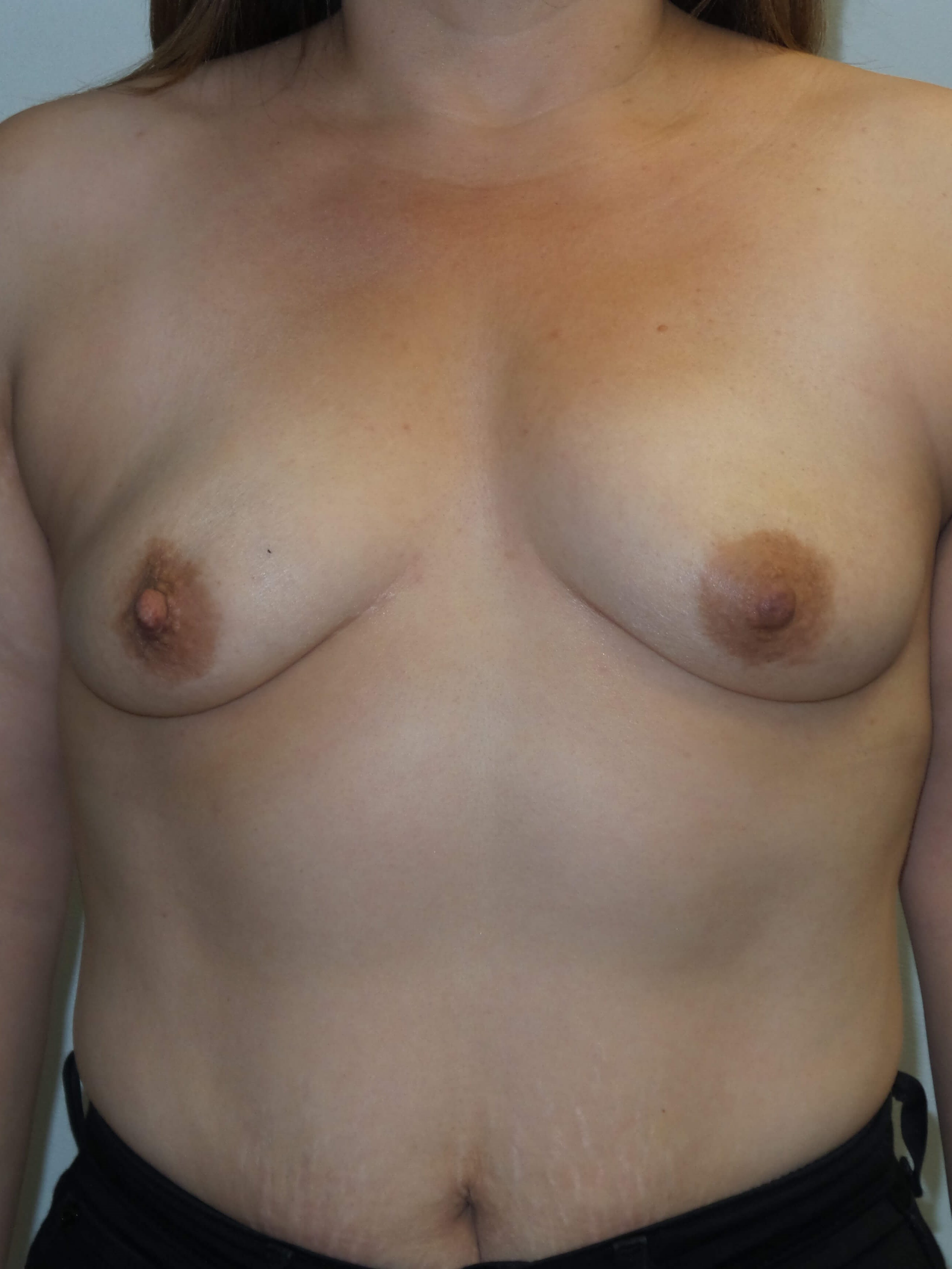 Westlake Woman Has Breast Aug Before