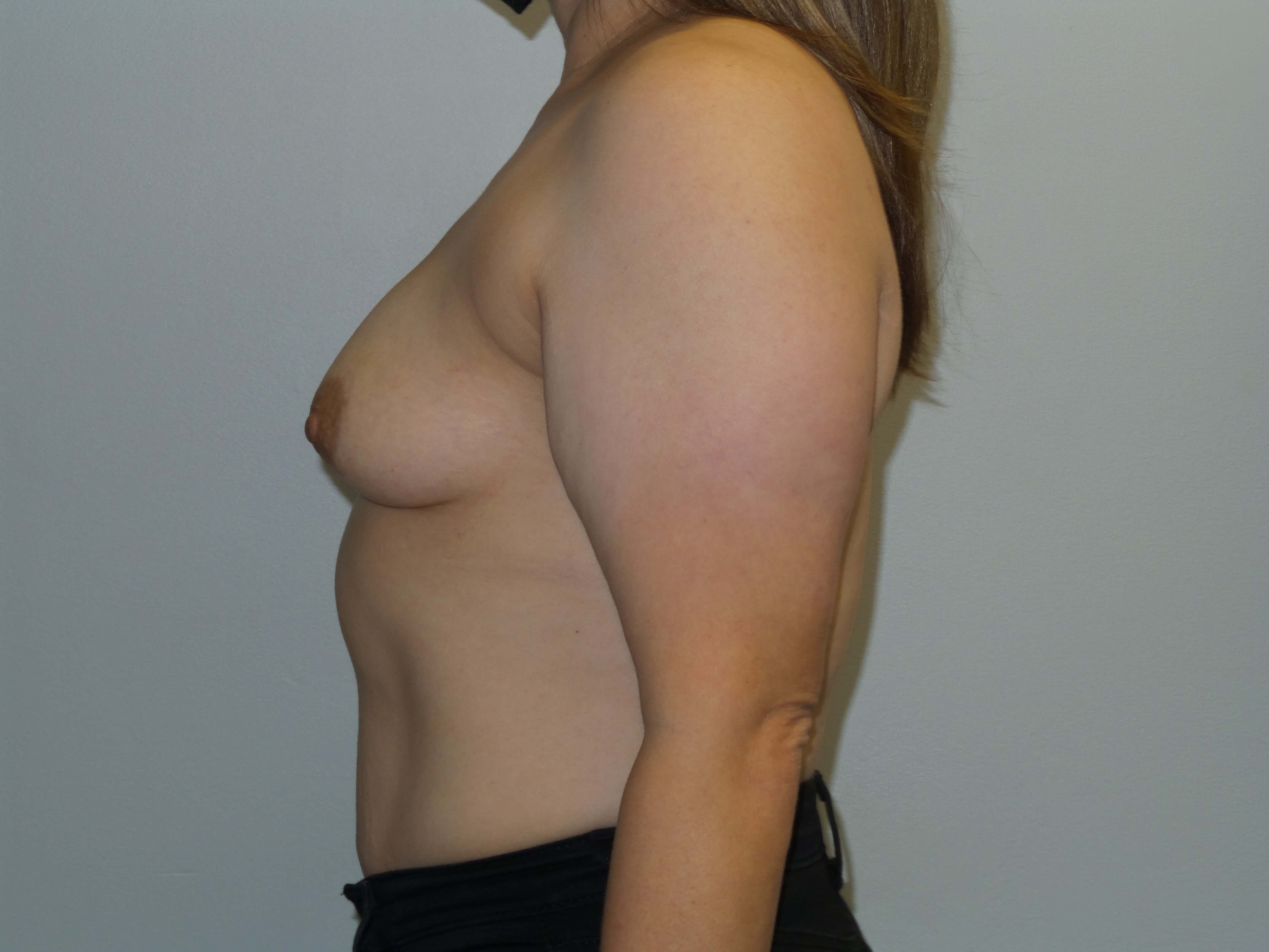 Westlake Woman Has Breast Aug Before