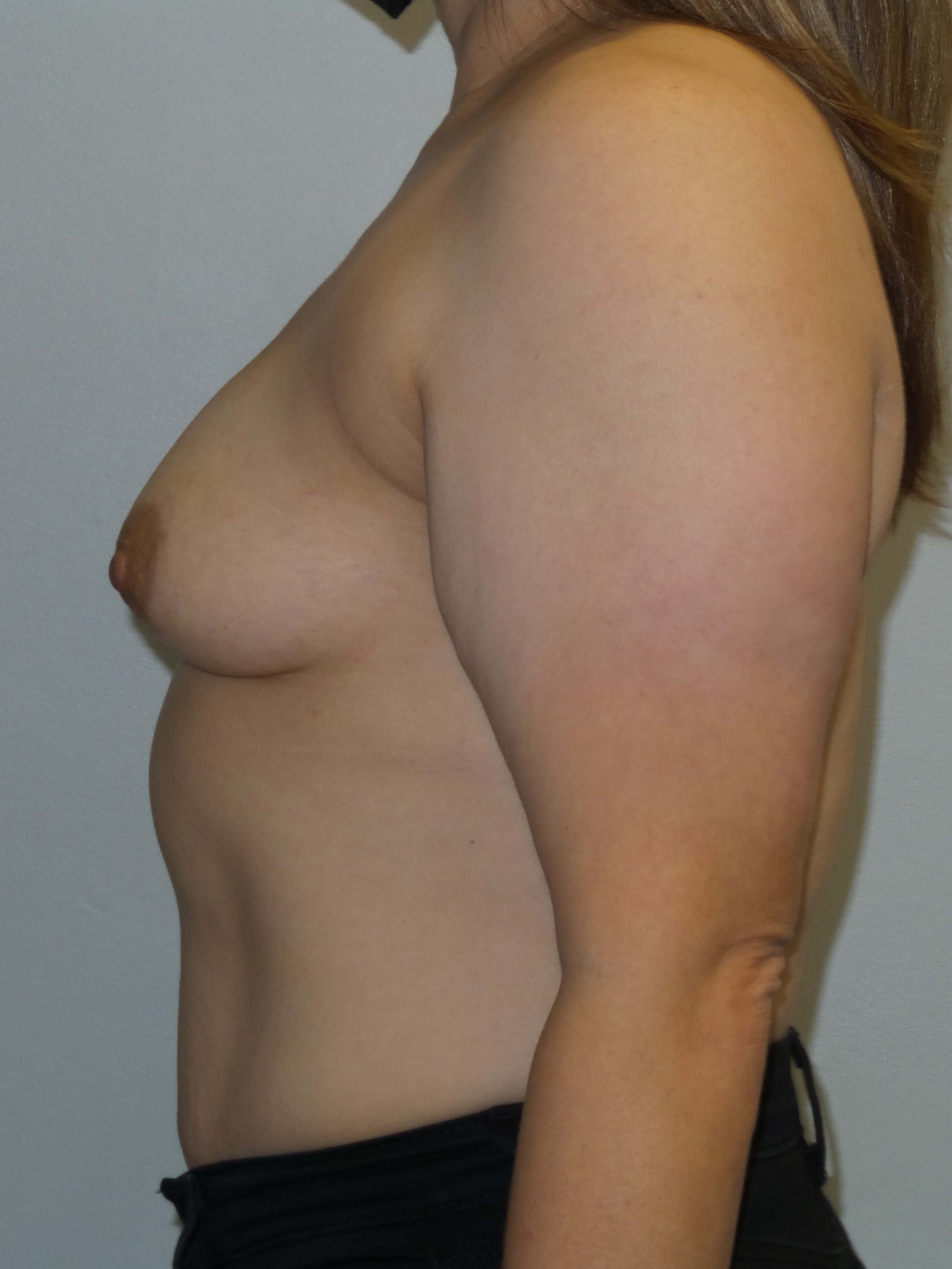 Westlake Woman Has Breast Aug Before