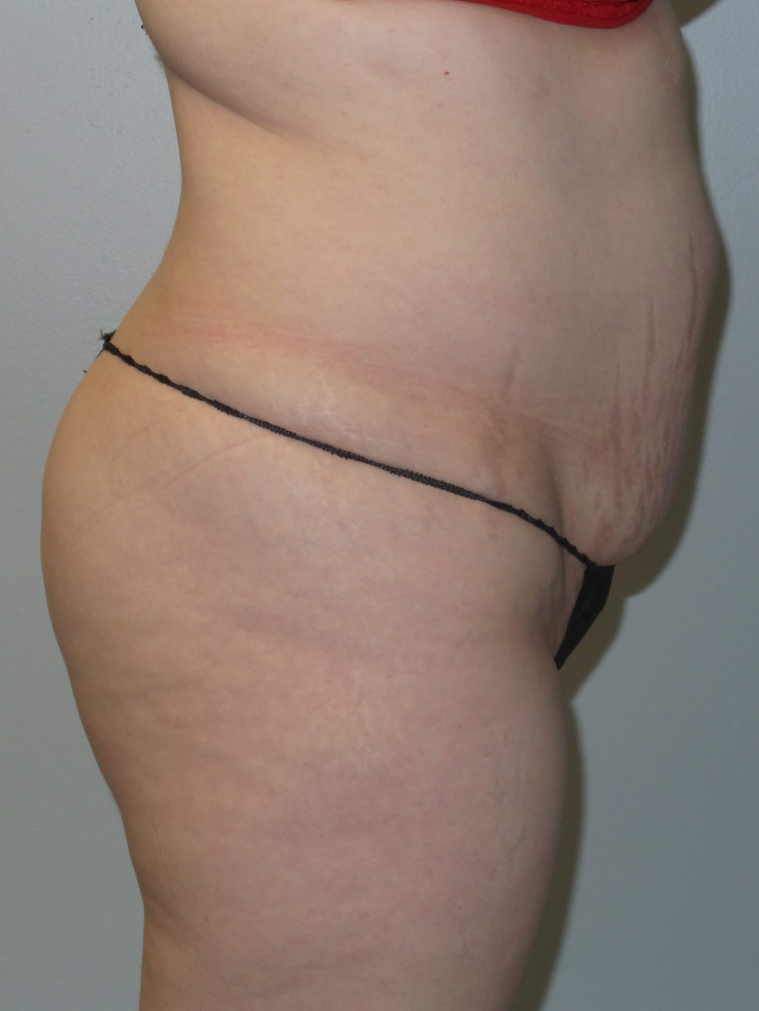 Woman has BBL Butt Lift Before