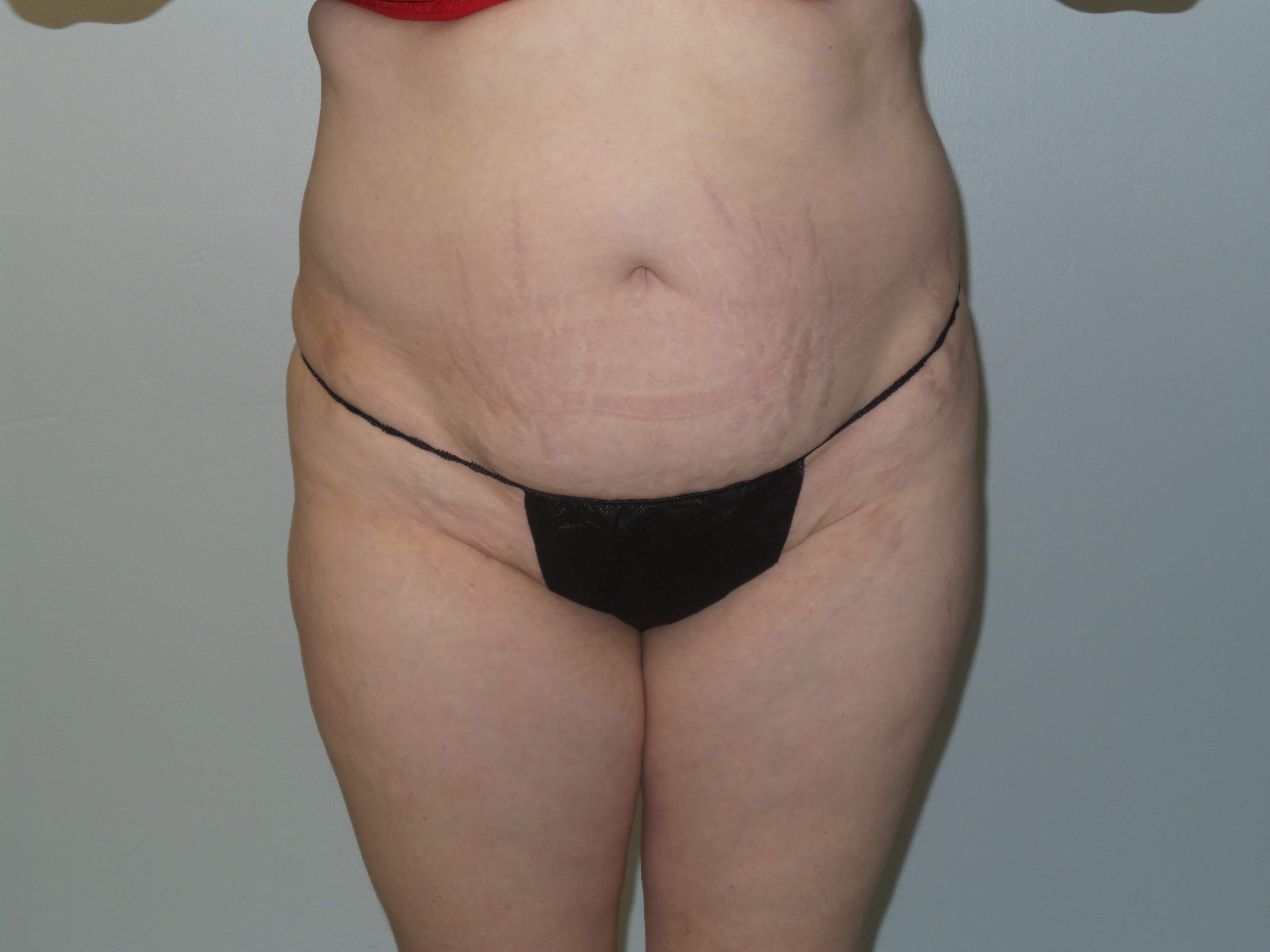 Woman has BBL Butt Lift Before