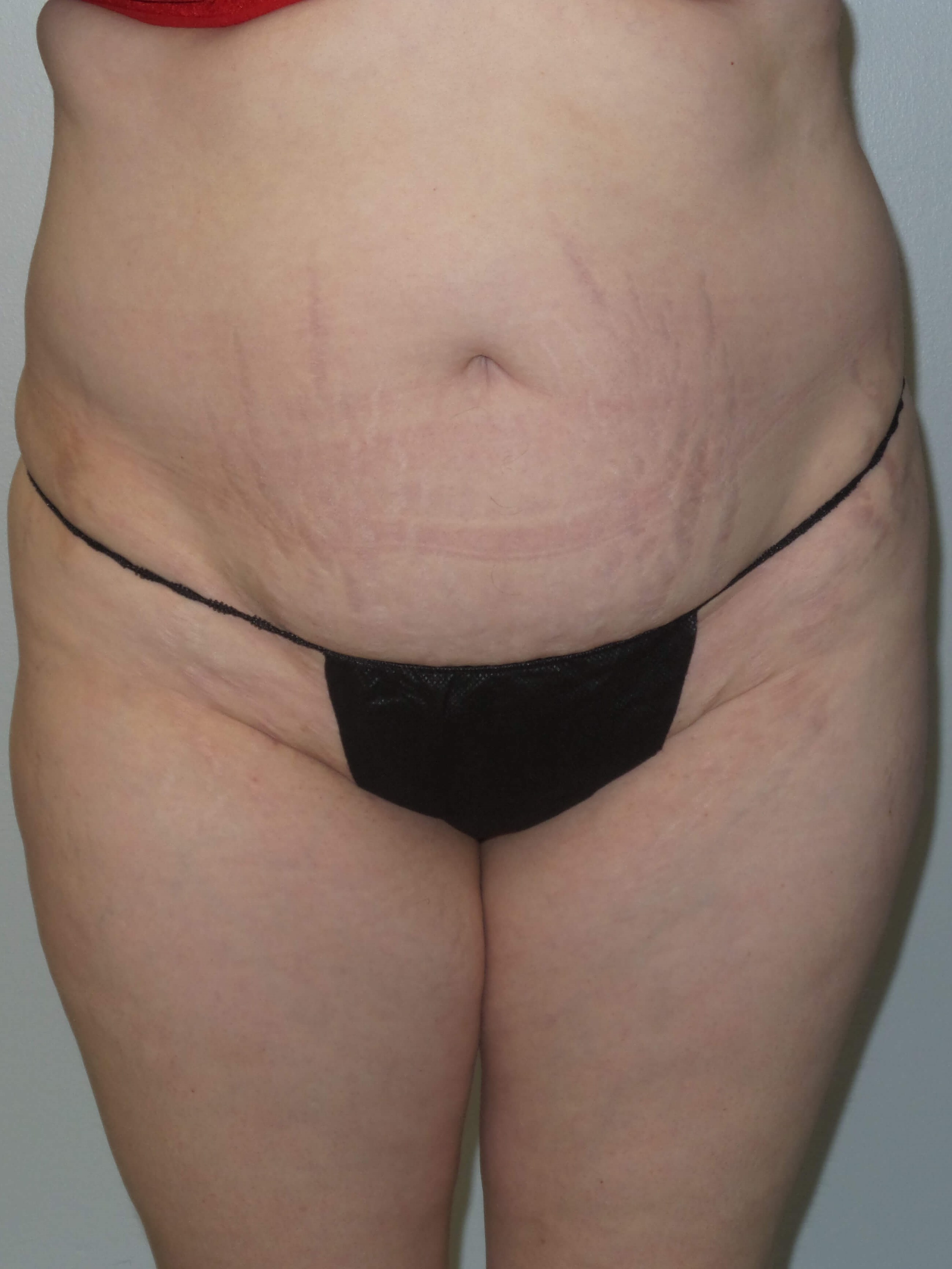 Woman has BBL Butt Lift Before