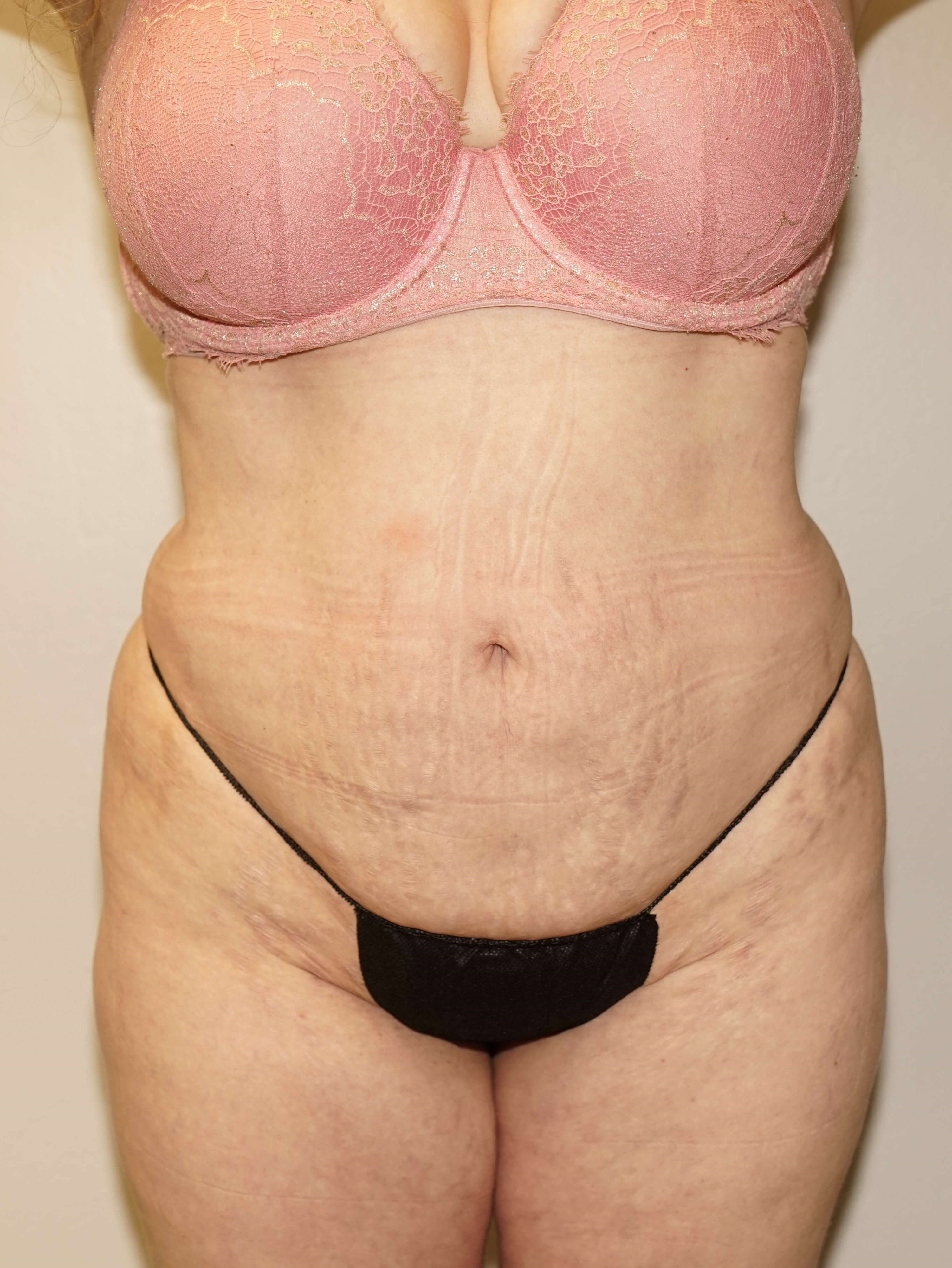 Woman has BBL Butt Lift After