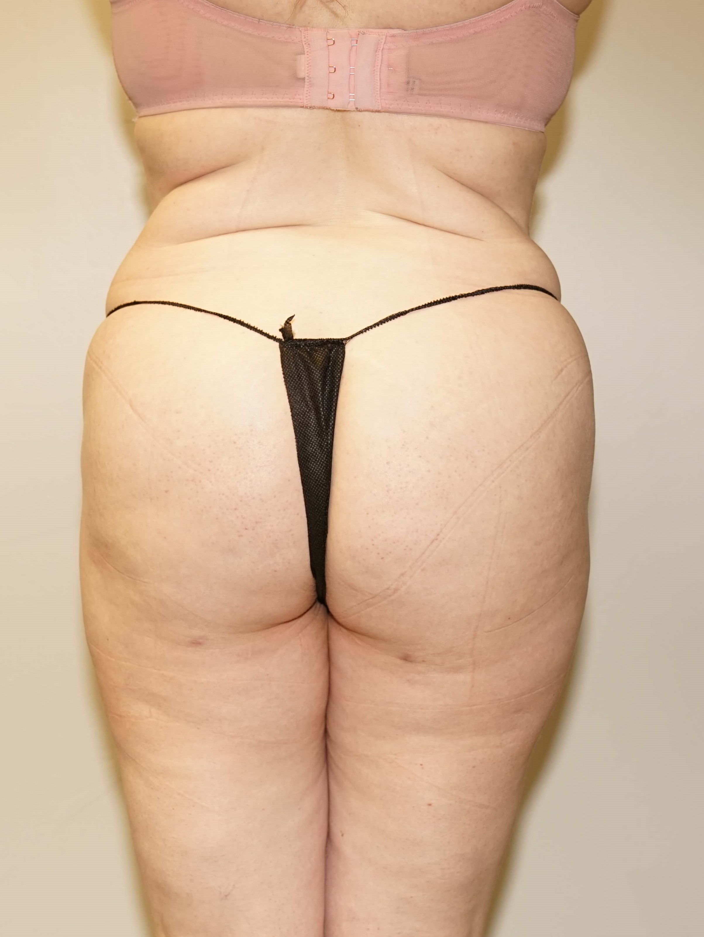 Woman has BBL Butt Lift After