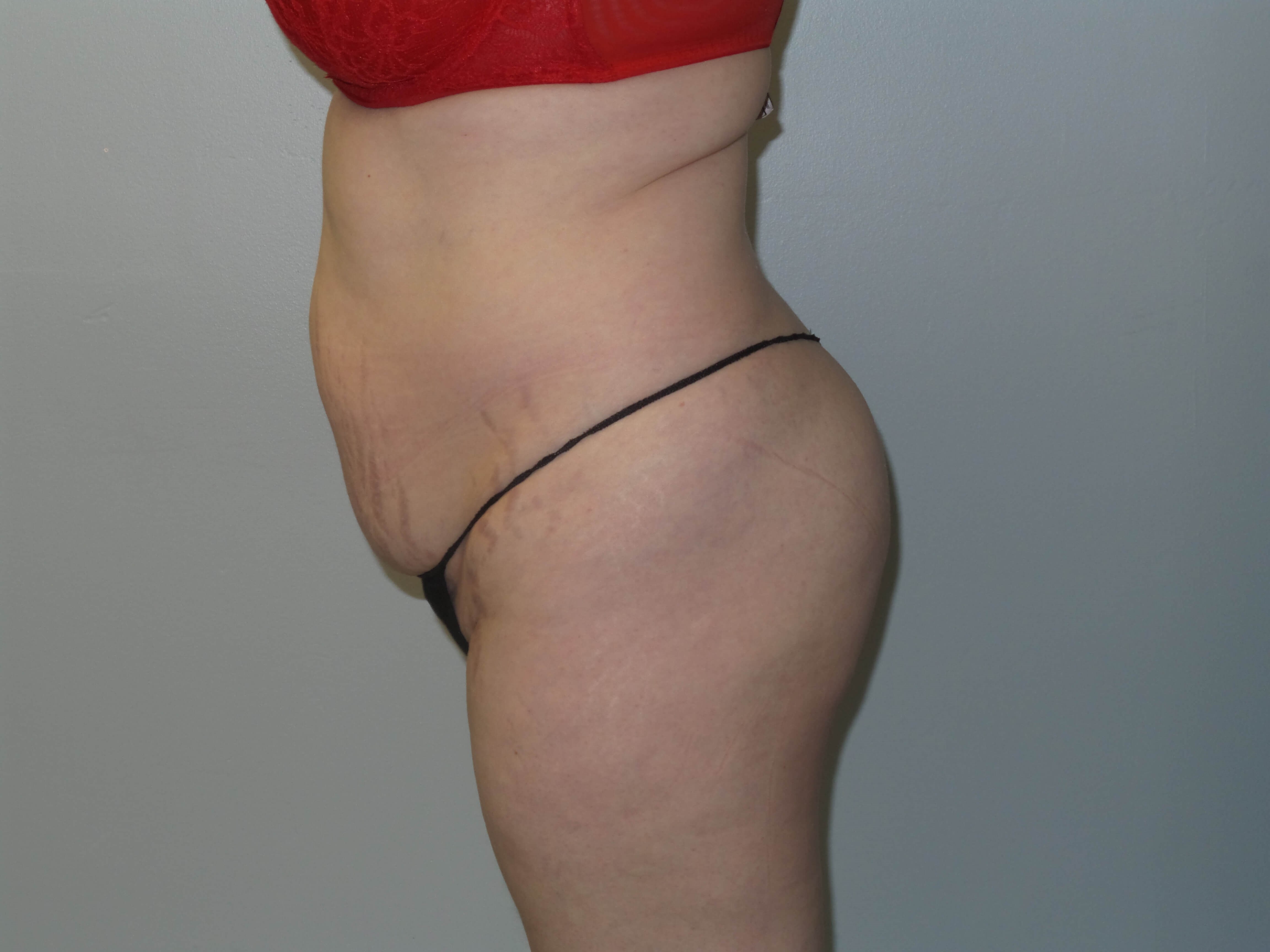 Woman has BBL Butt Lift Before