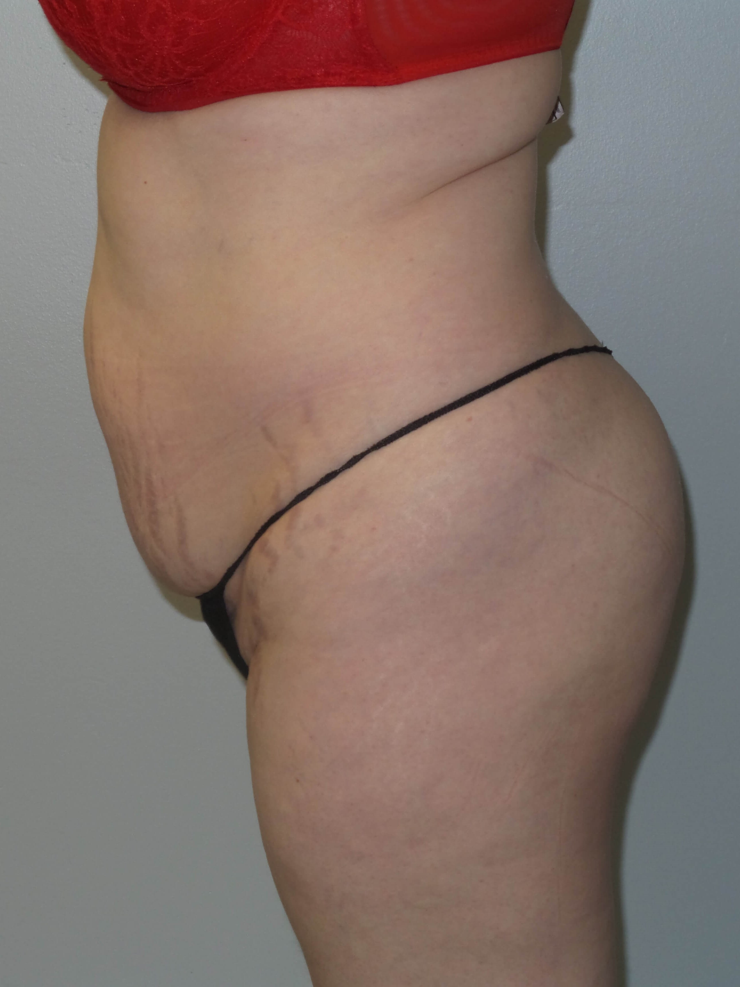 Woman has BBL Butt Lift Before