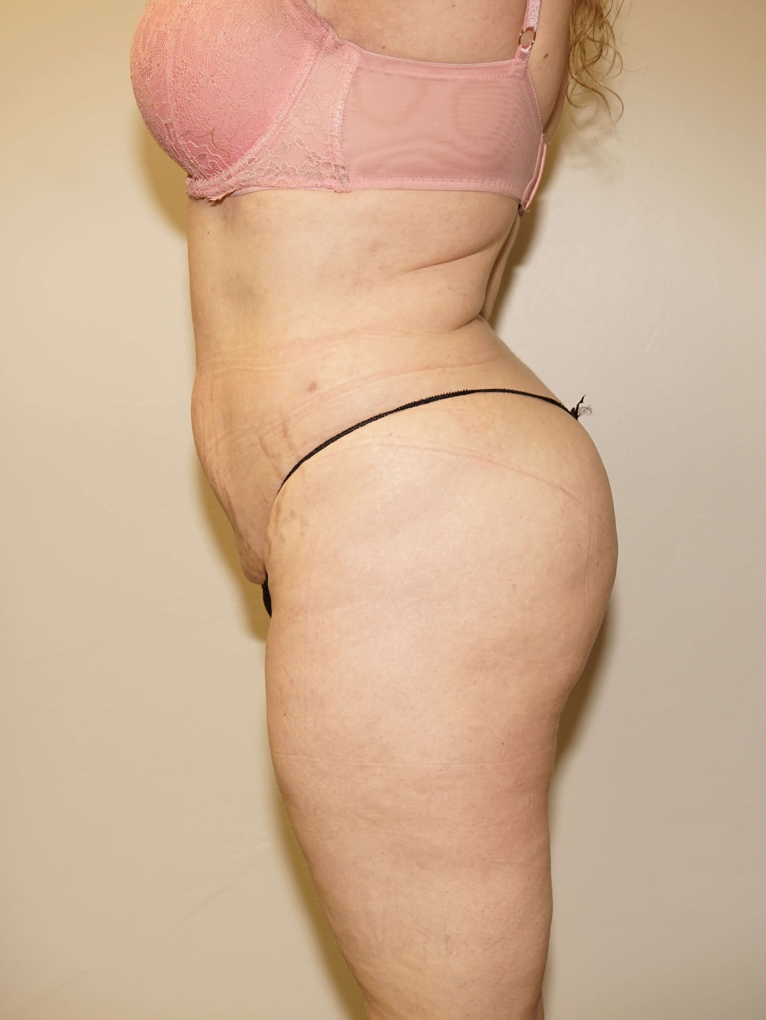 Woman has BBL Butt Lift After