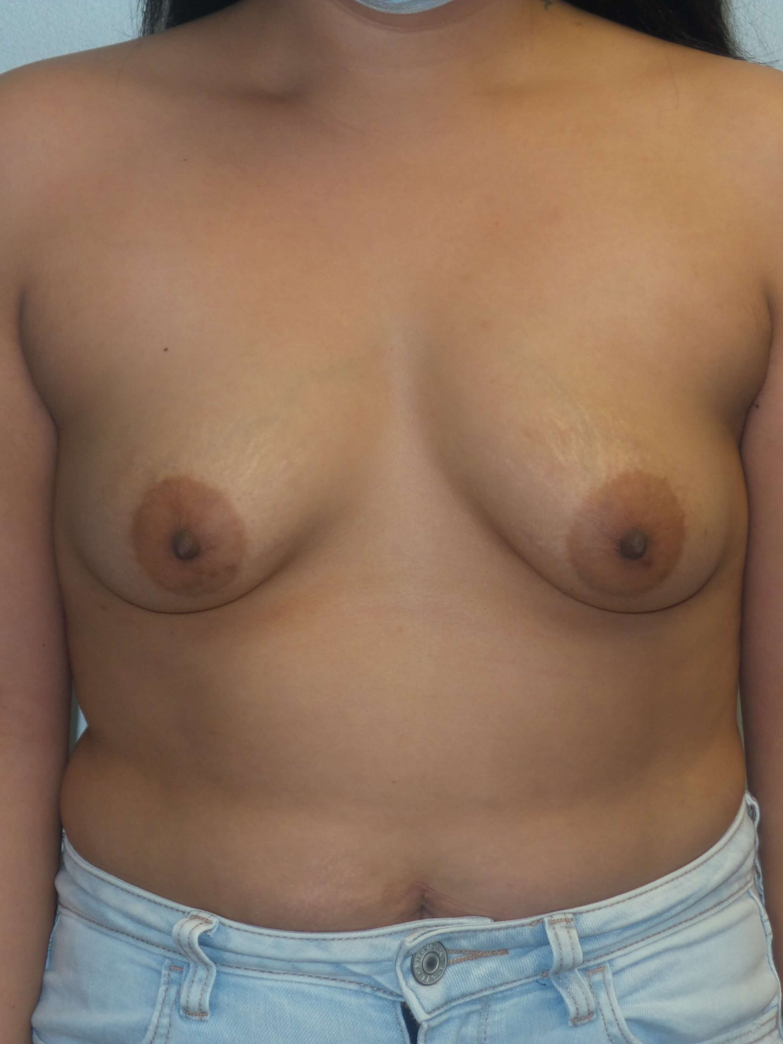 Westlake Woman Has Breast Aug Before