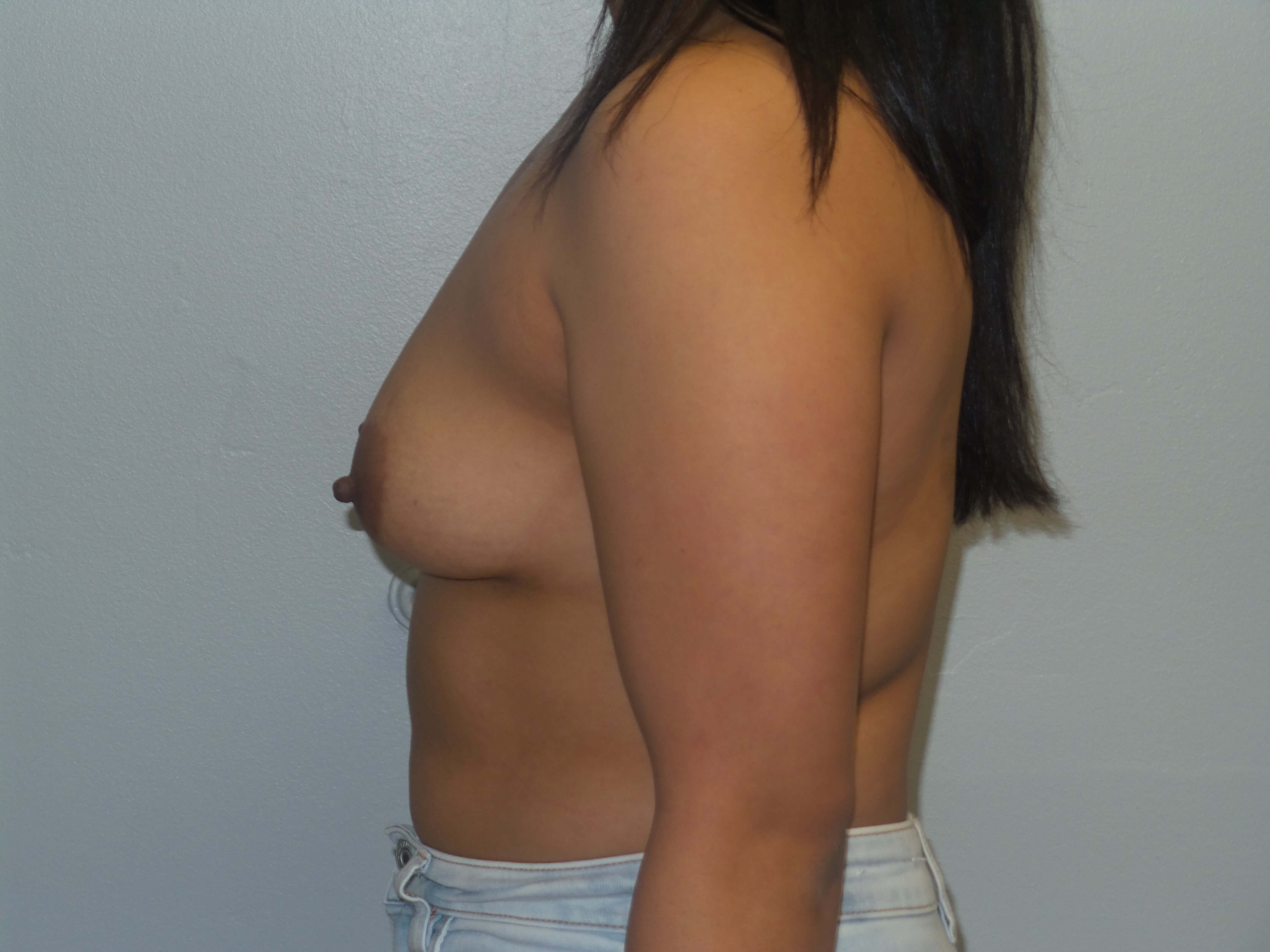 Westlake Woman Has Breast Aug Before