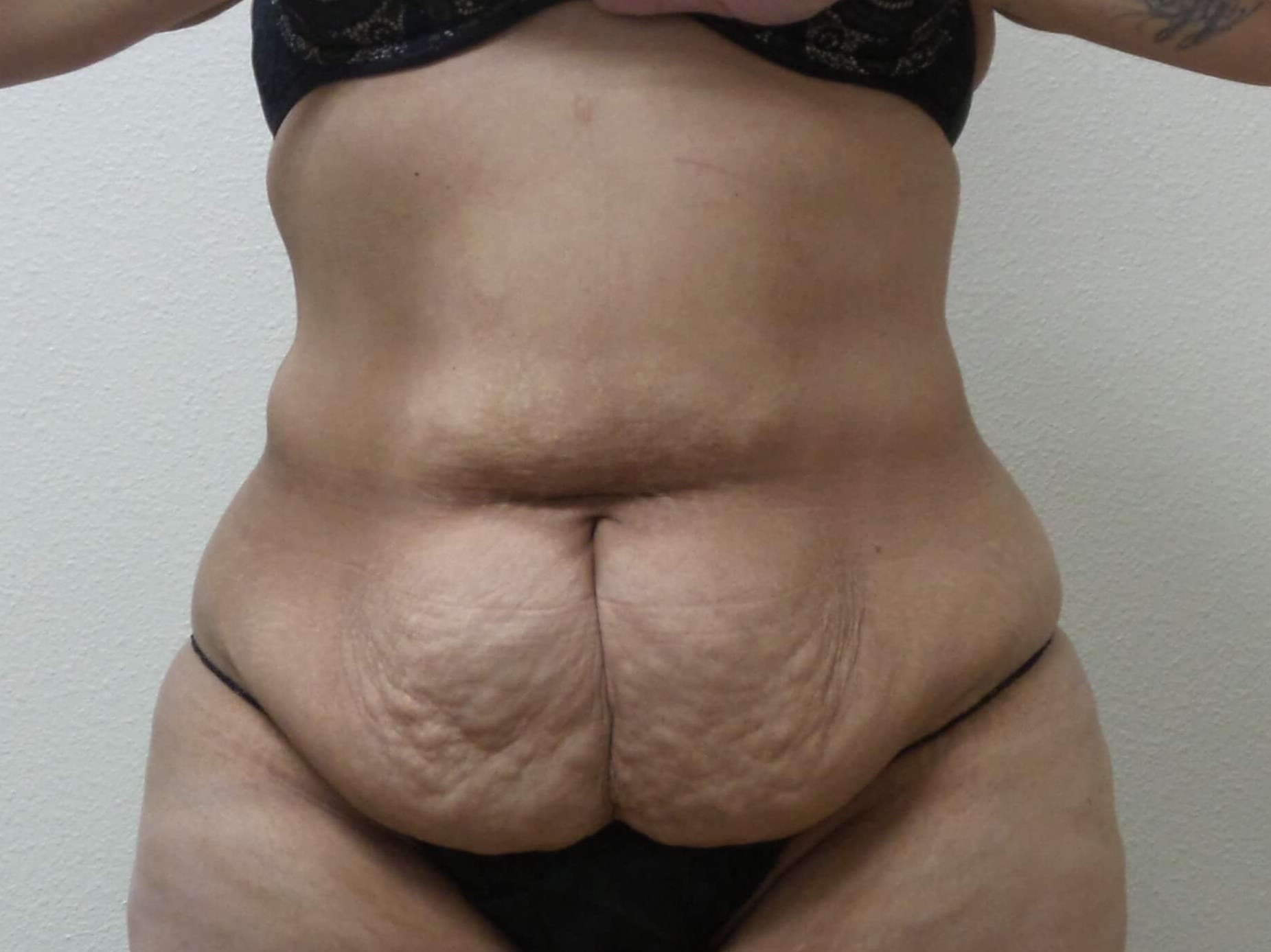 Woman Has Tummy Tuck Lipo Before