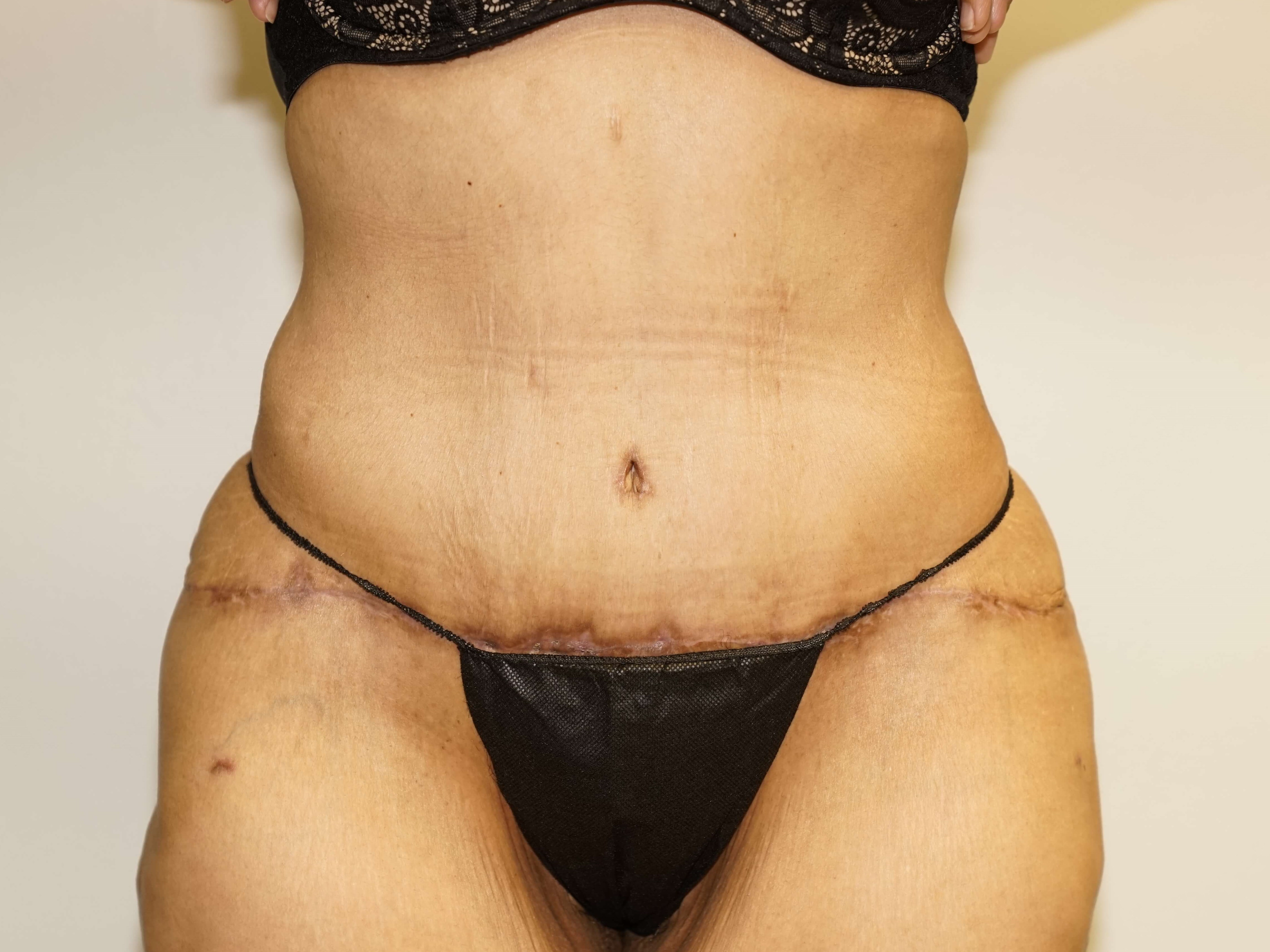Woman Has Tummy Tuck Lipo After