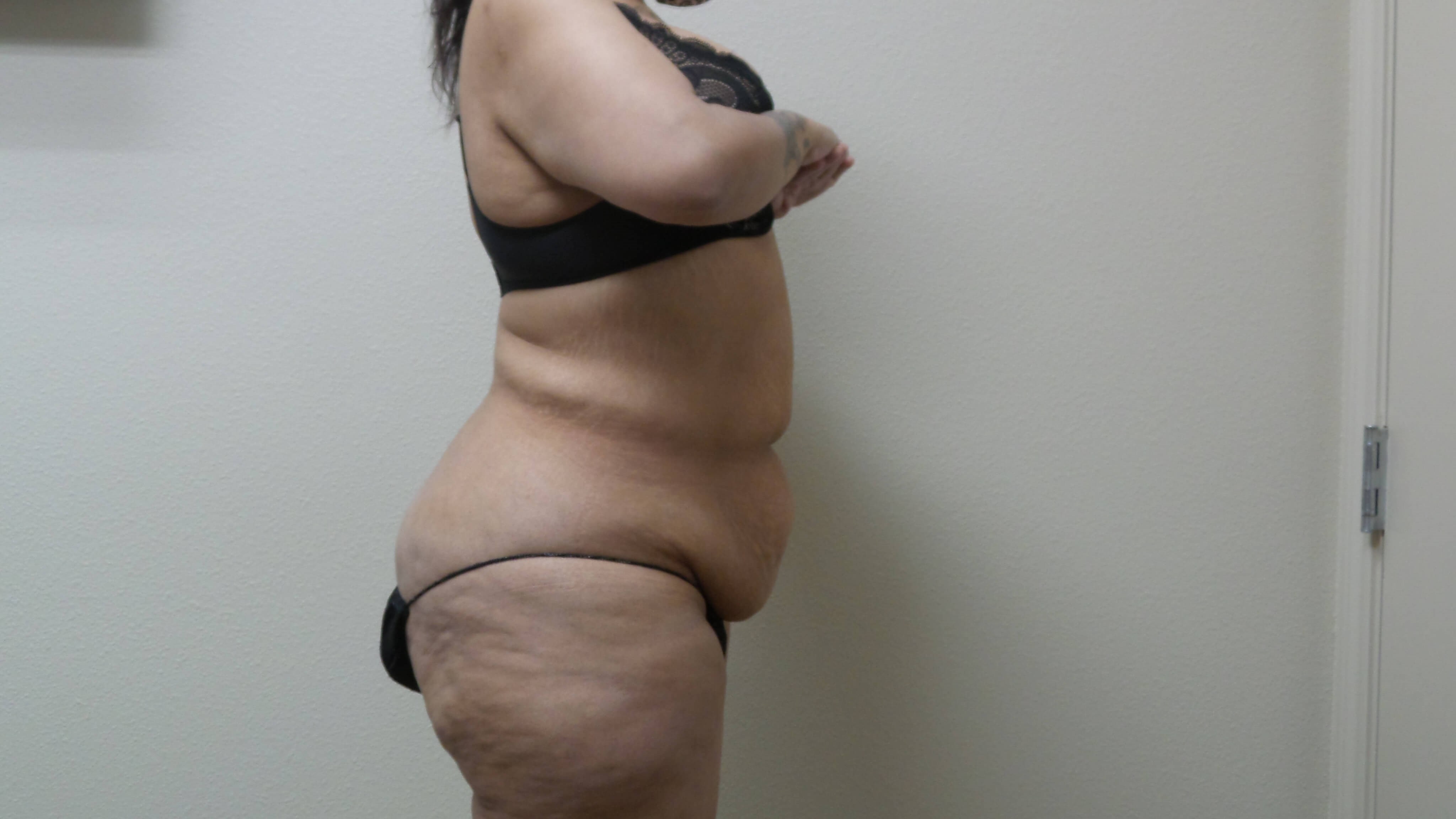 Woman Has Tummy Tuck Lipo Before