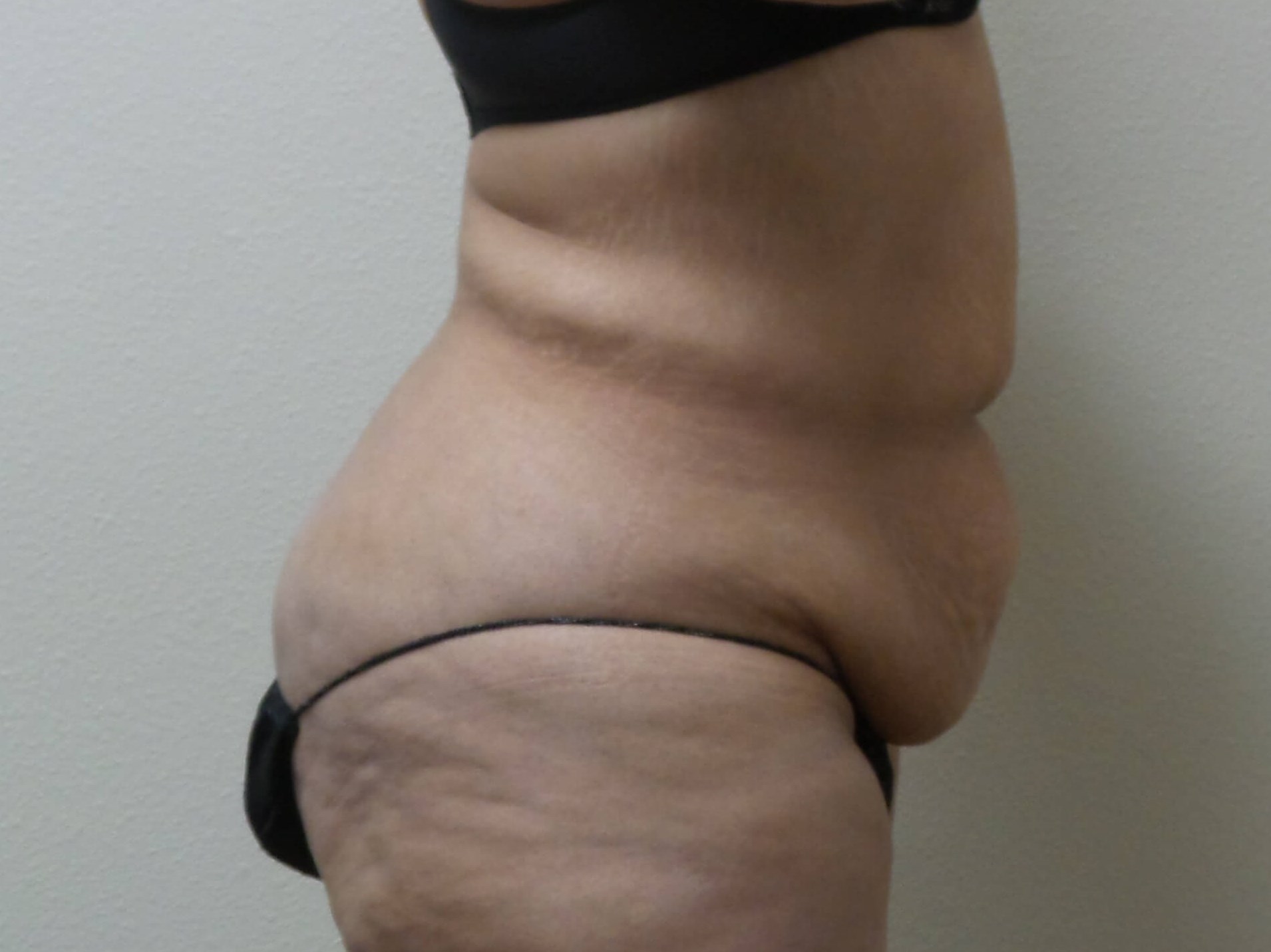 Woman Has Tummy Tuck Lipo Before