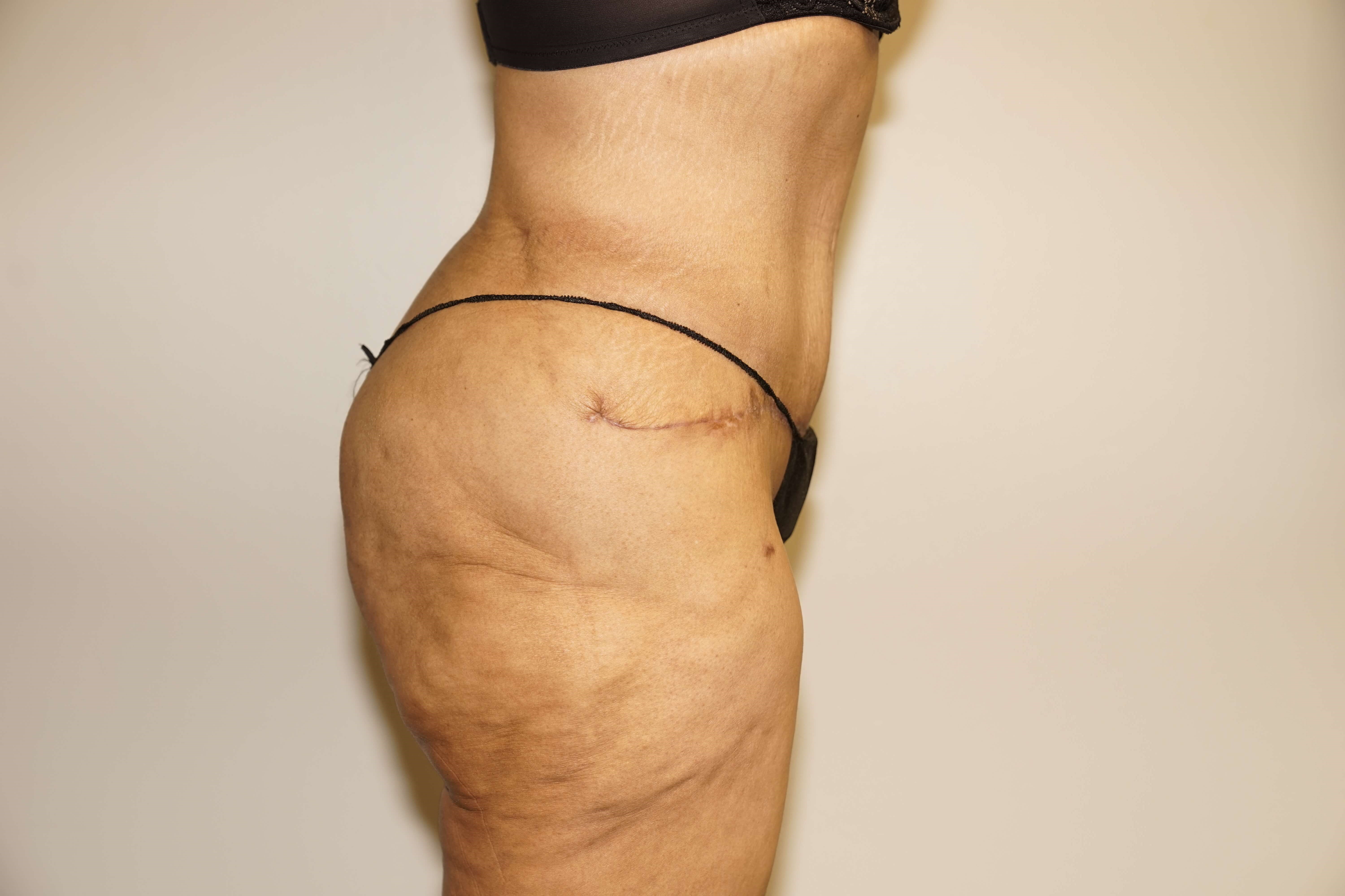 Woman Has Tummy Tuck Lipo After