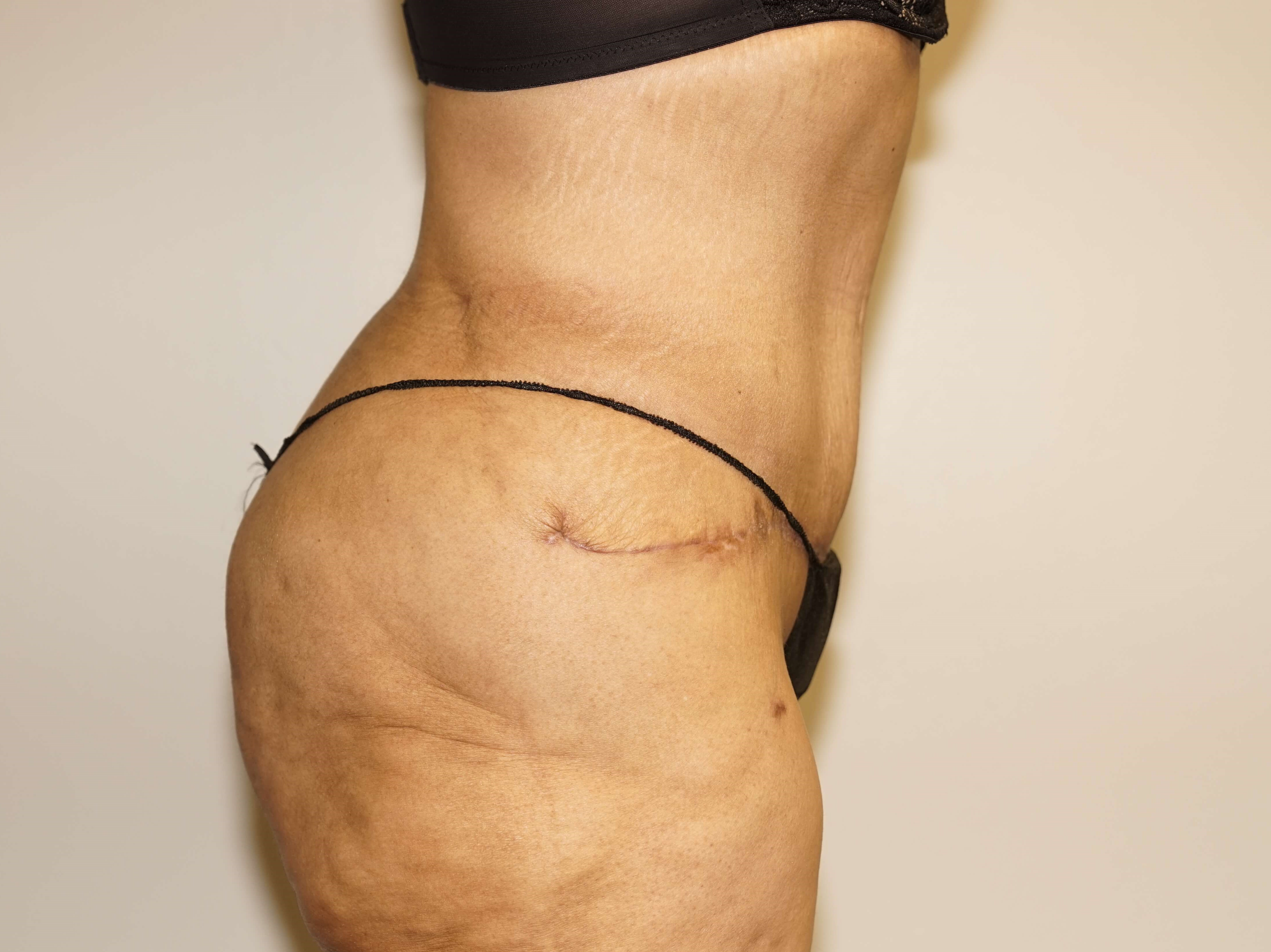 Woman Has Tummy Tuck Lipo After