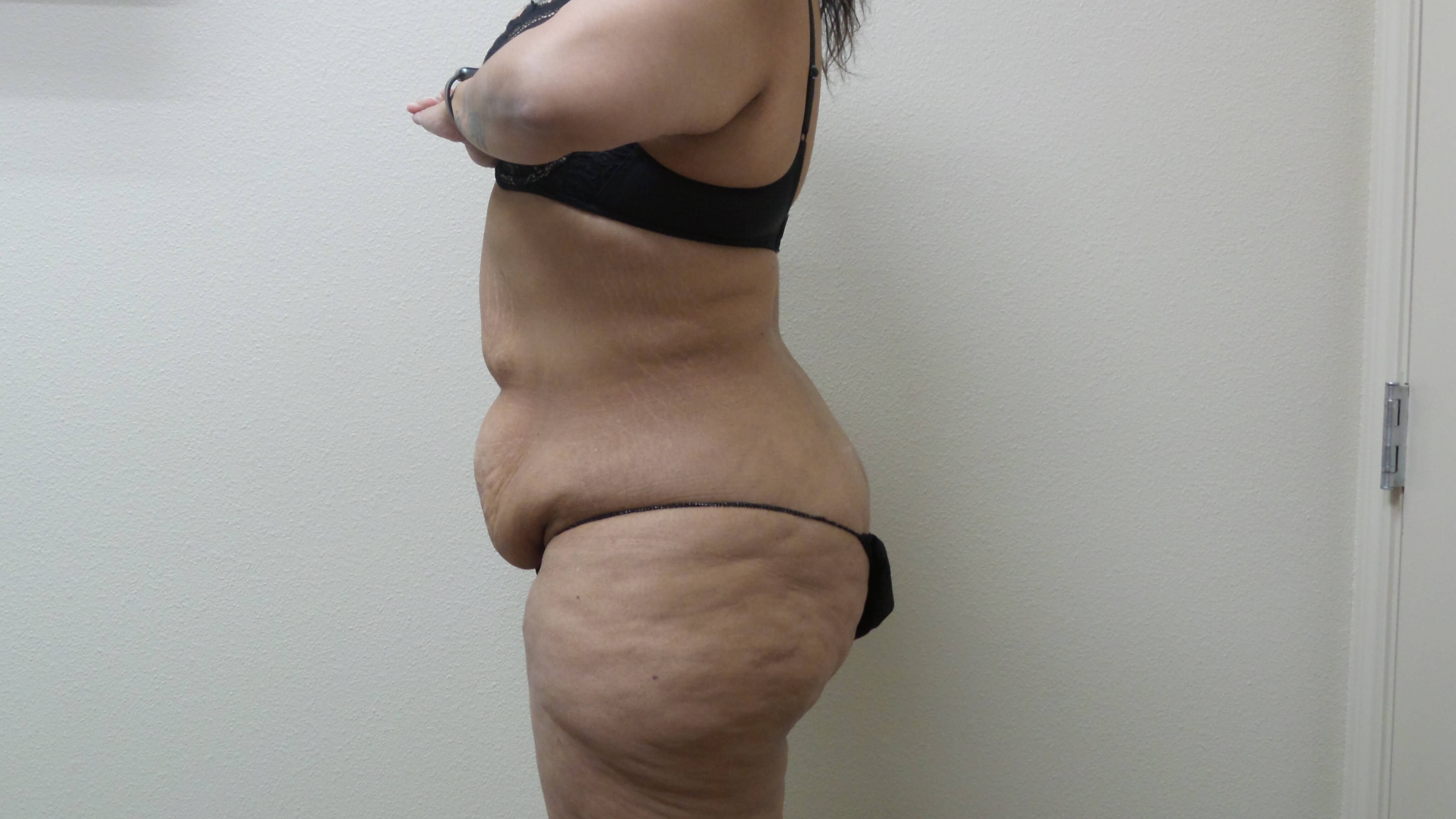 Woman Has Tummy Tuck Lipo Before