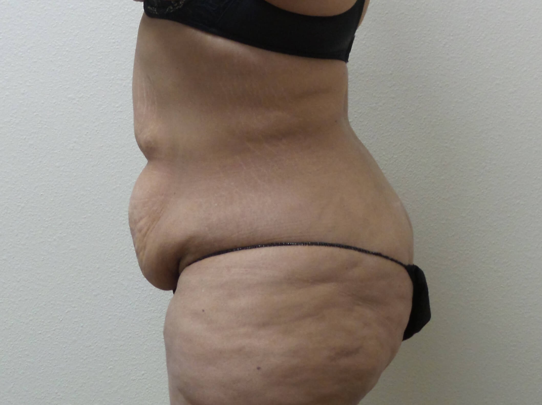 Woman Has Tummy Tuck Lipo Before