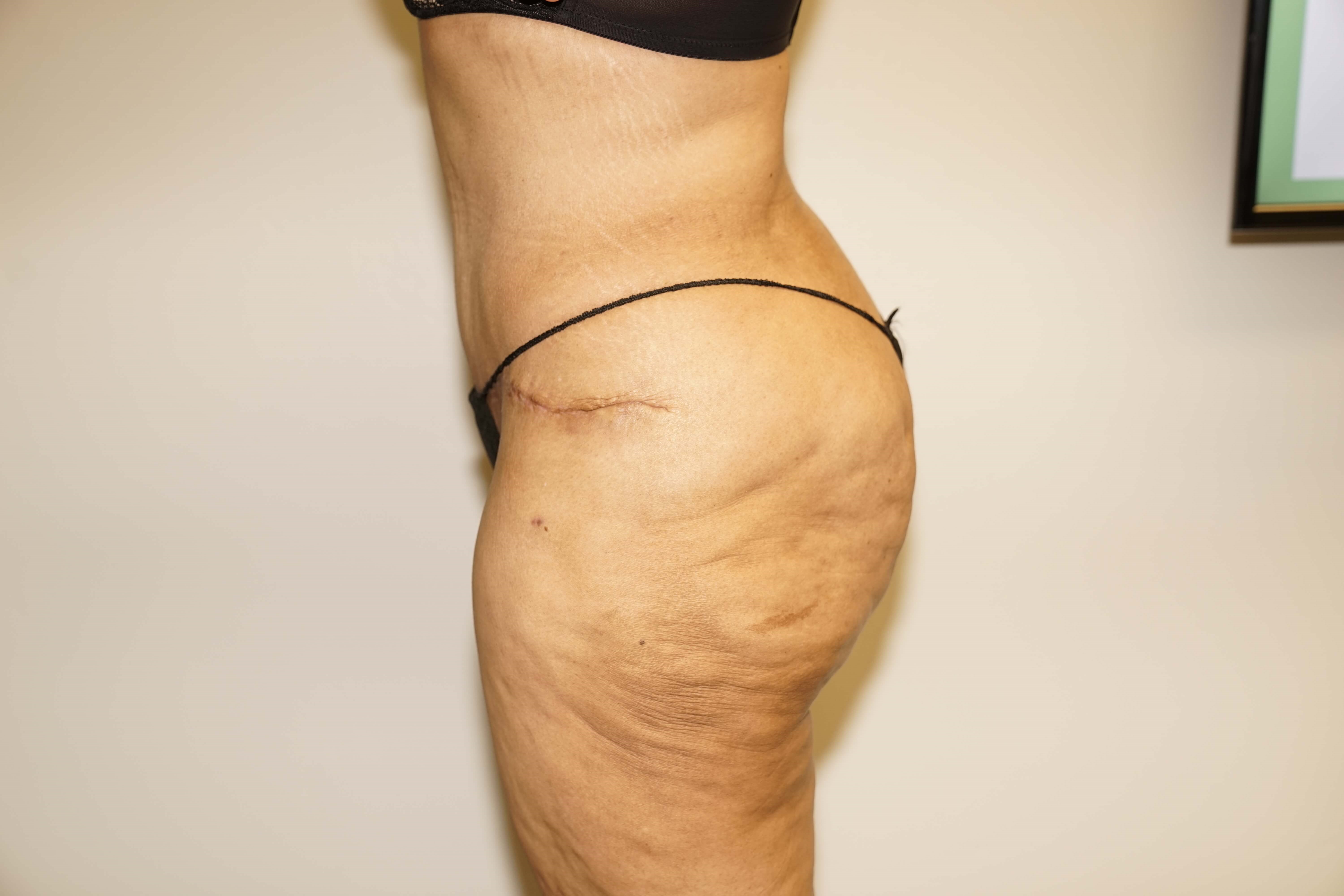 Woman Has Tummy Tuck Lipo After