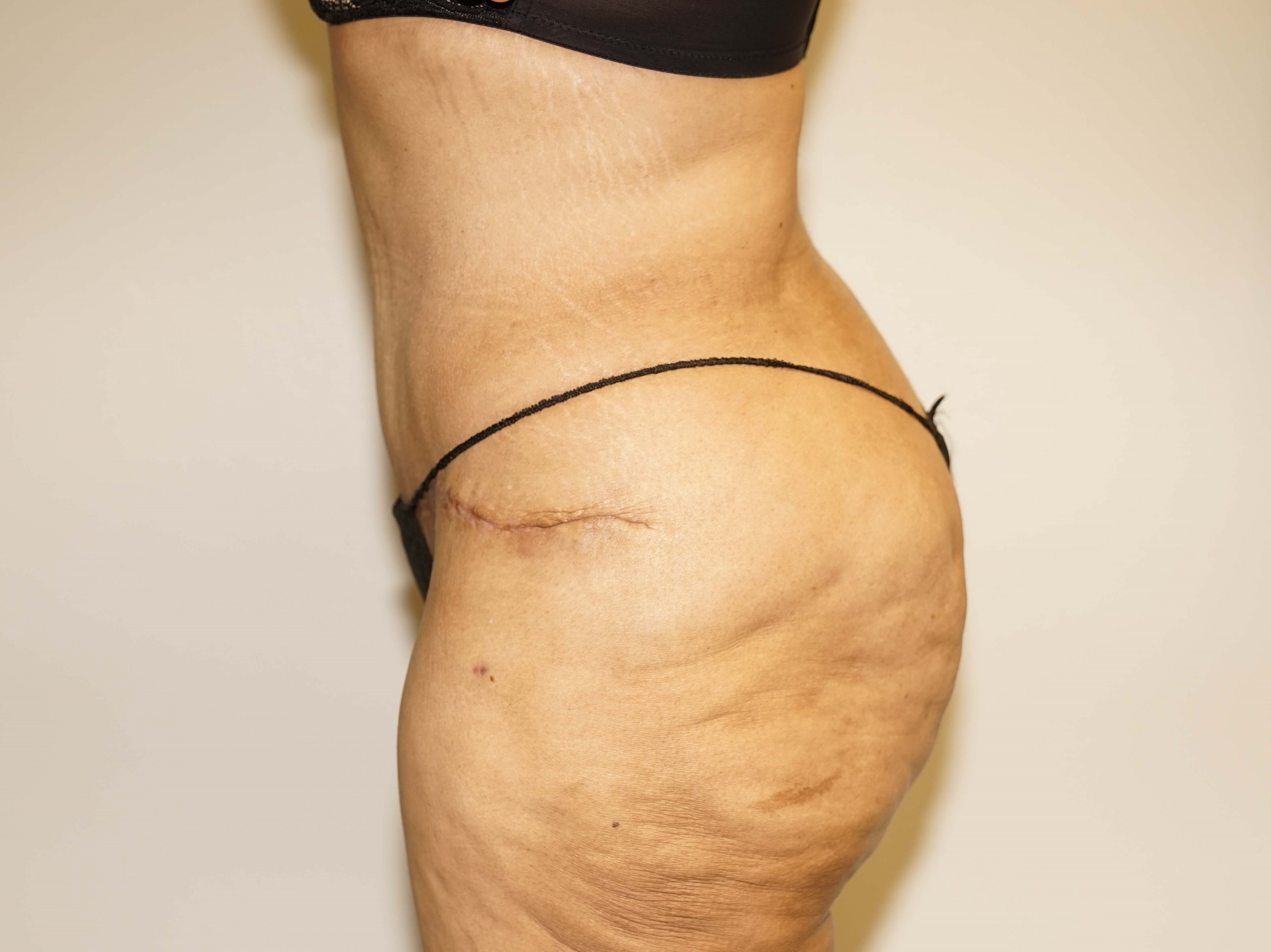 Woman Has Tummy Tuck Lipo After