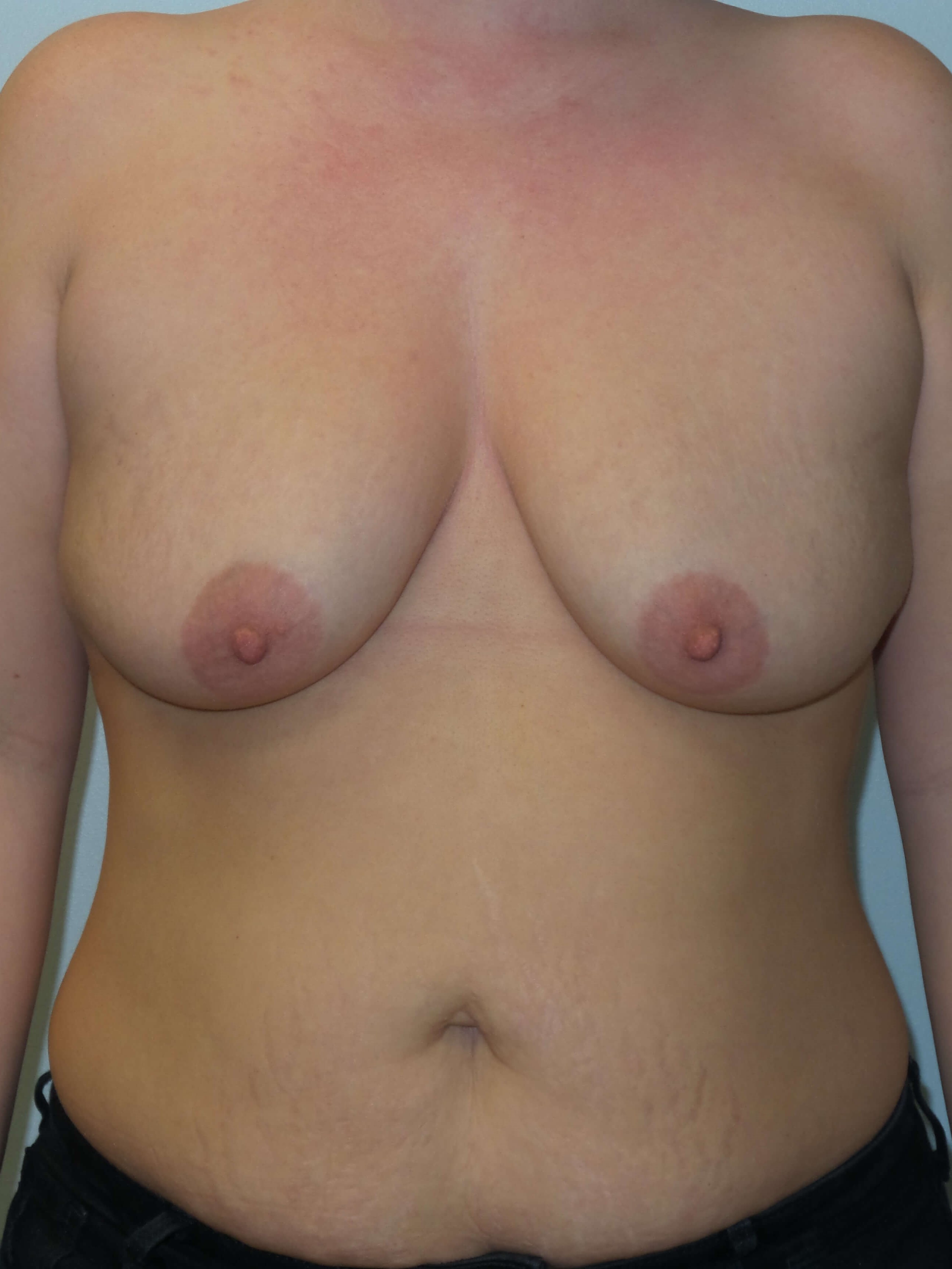 Woman has Breast Lift + Aug Before