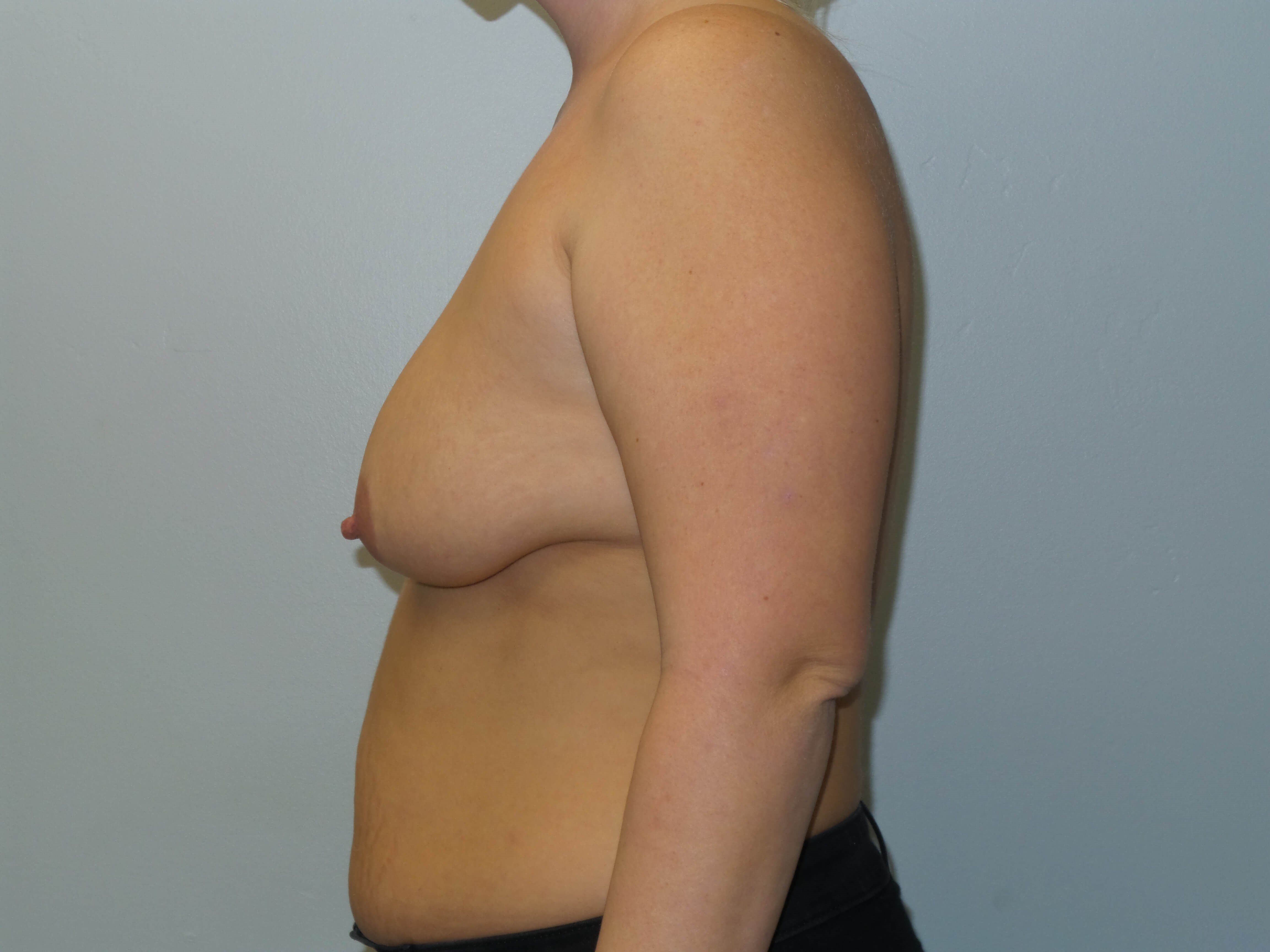 Woman has Breast Lift + Aug Before