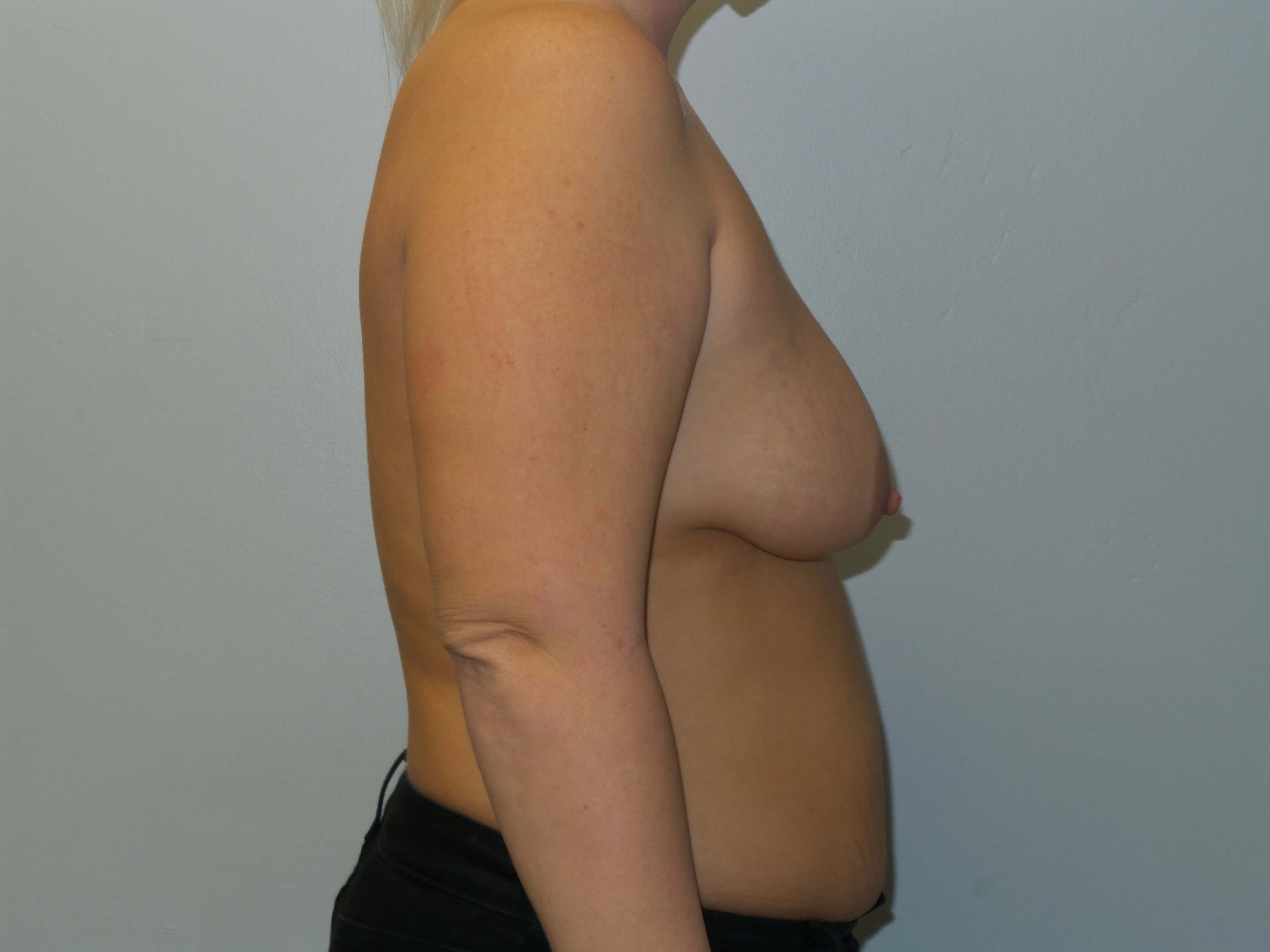 Woman has Breast Lift + Aug Before