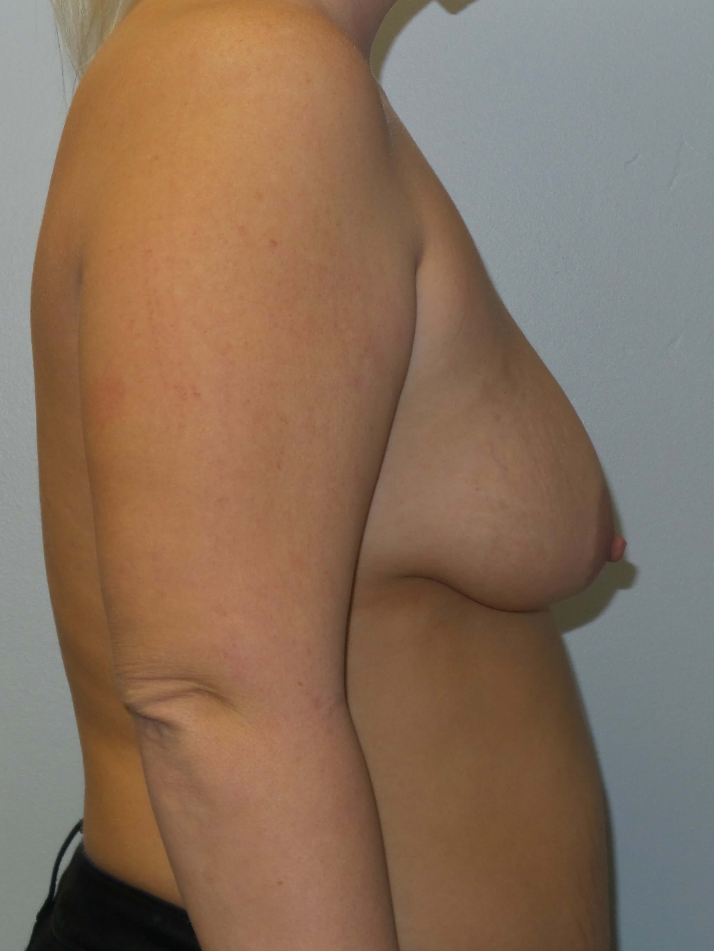Woman has Breast Lift + Aug Before