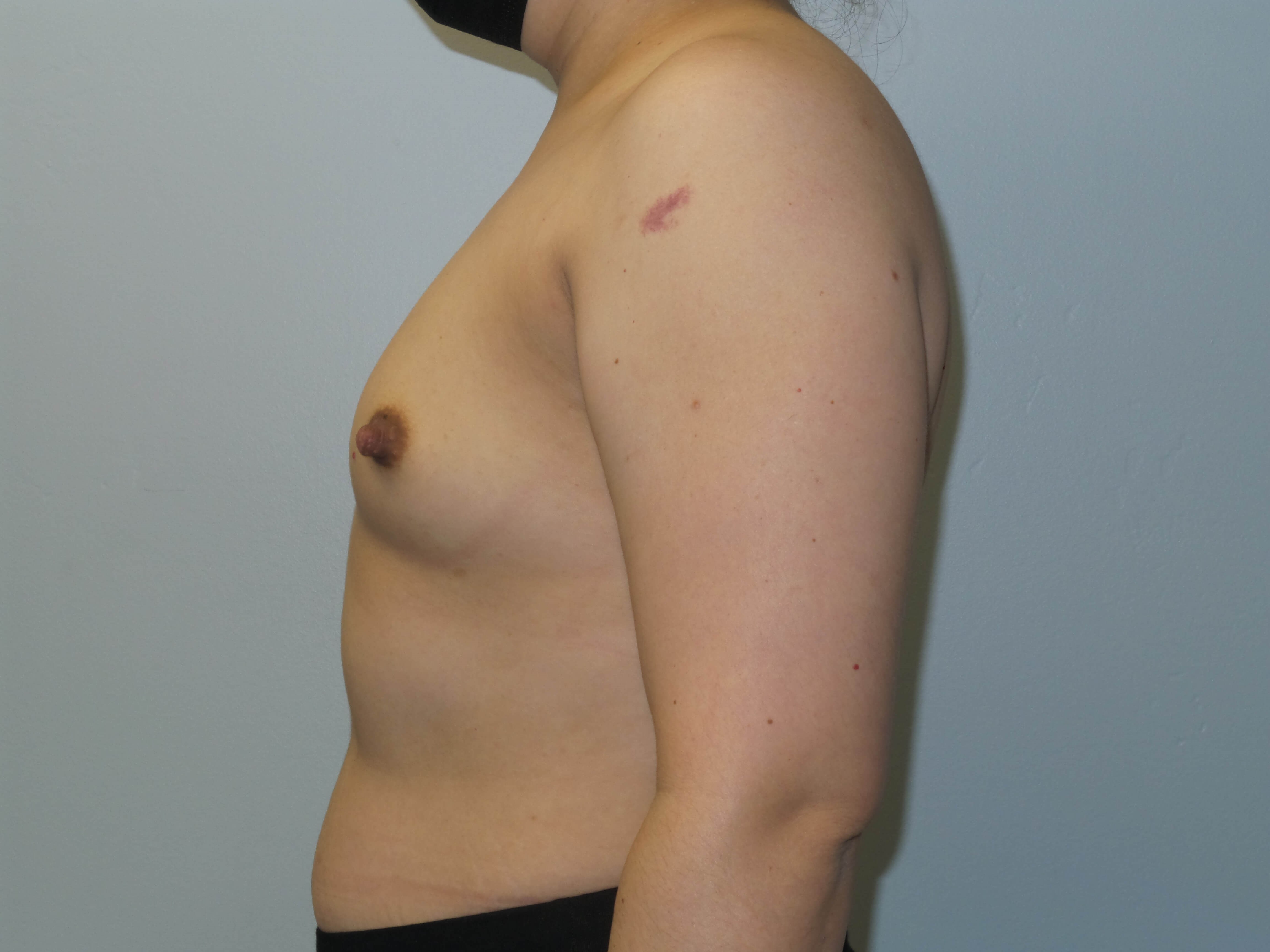 Woman has Mommy Makeover Before