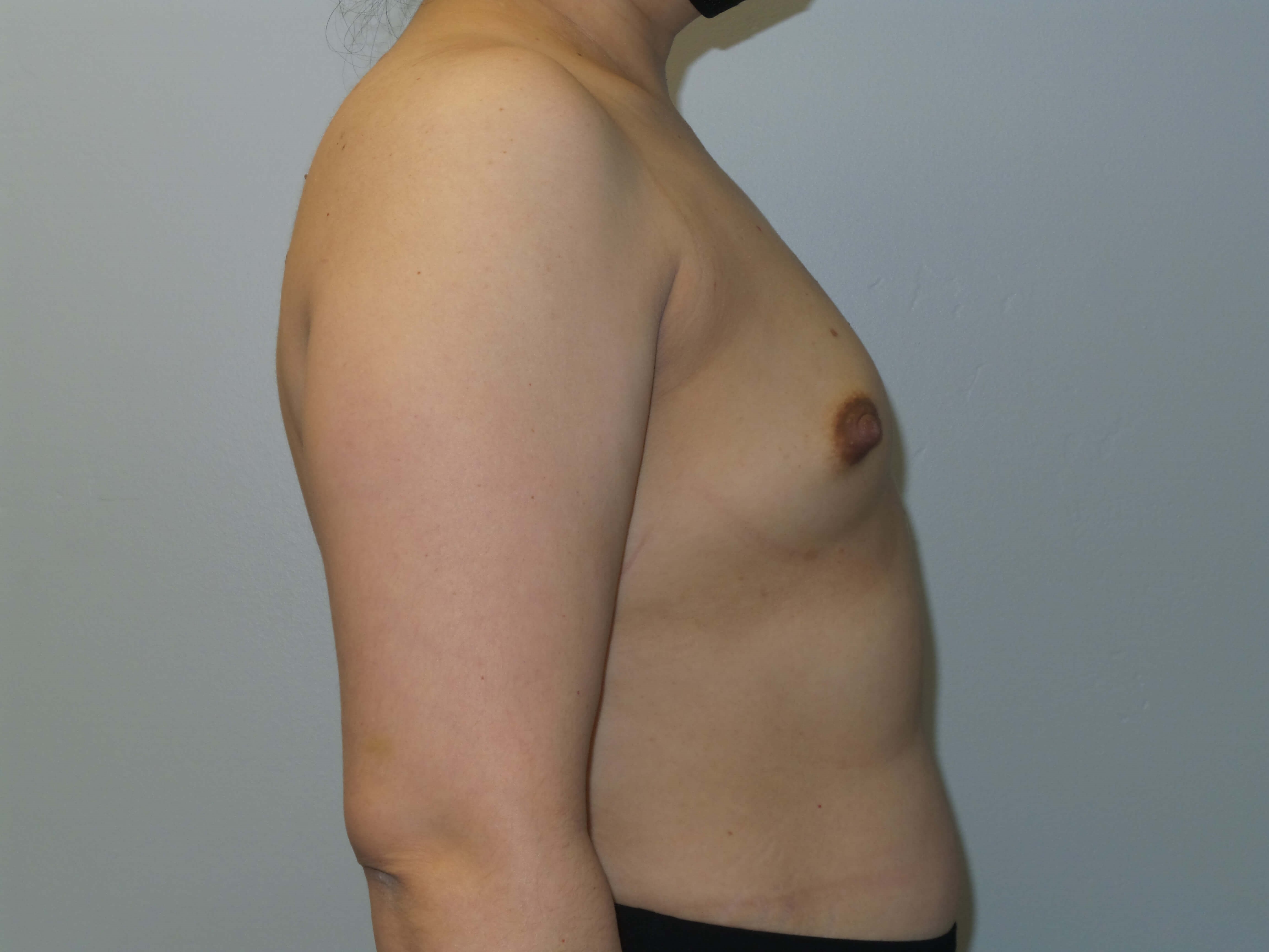 Woman has Mommy Makeover Before