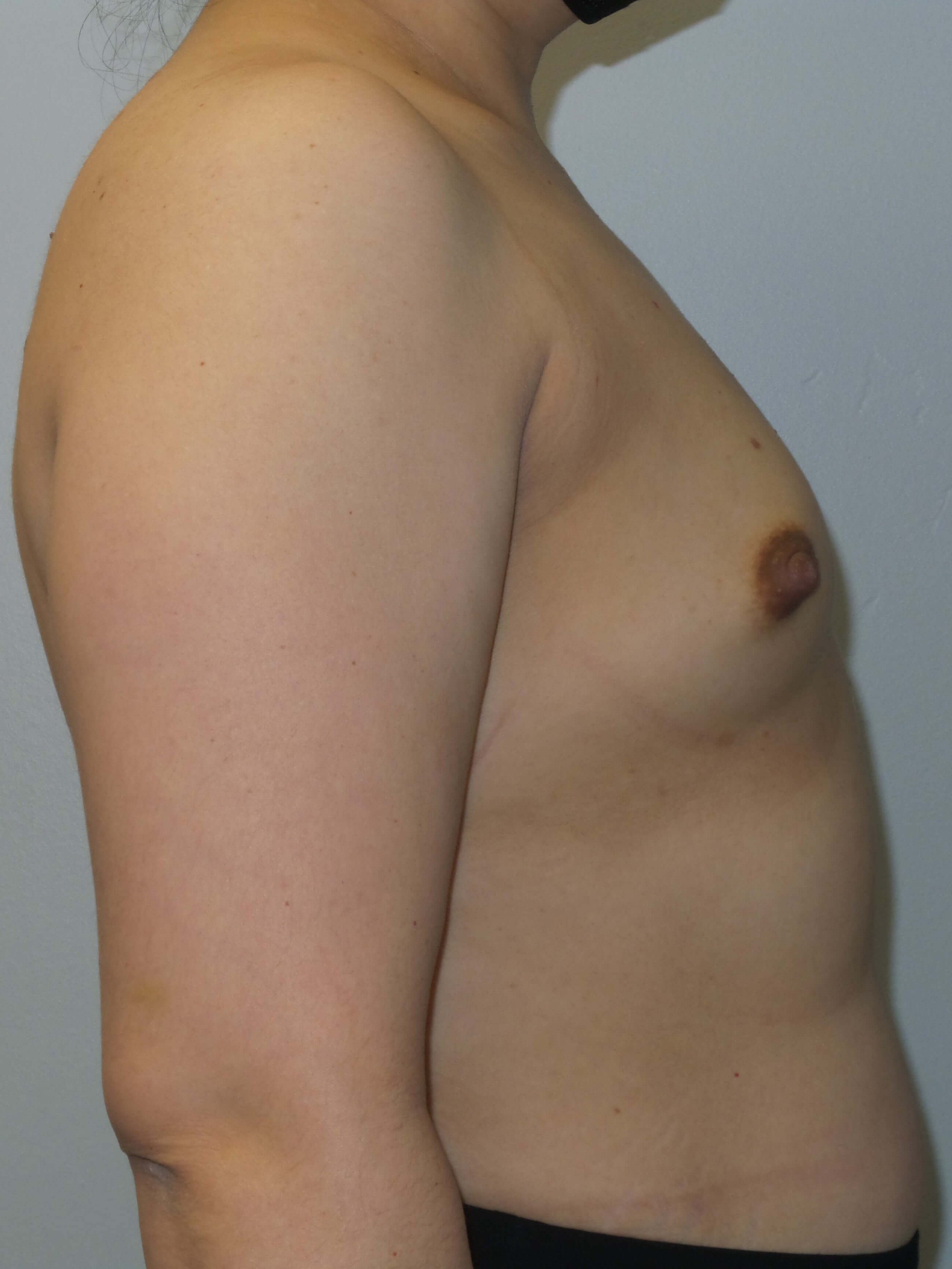 Woman has Mommy Makeover Before