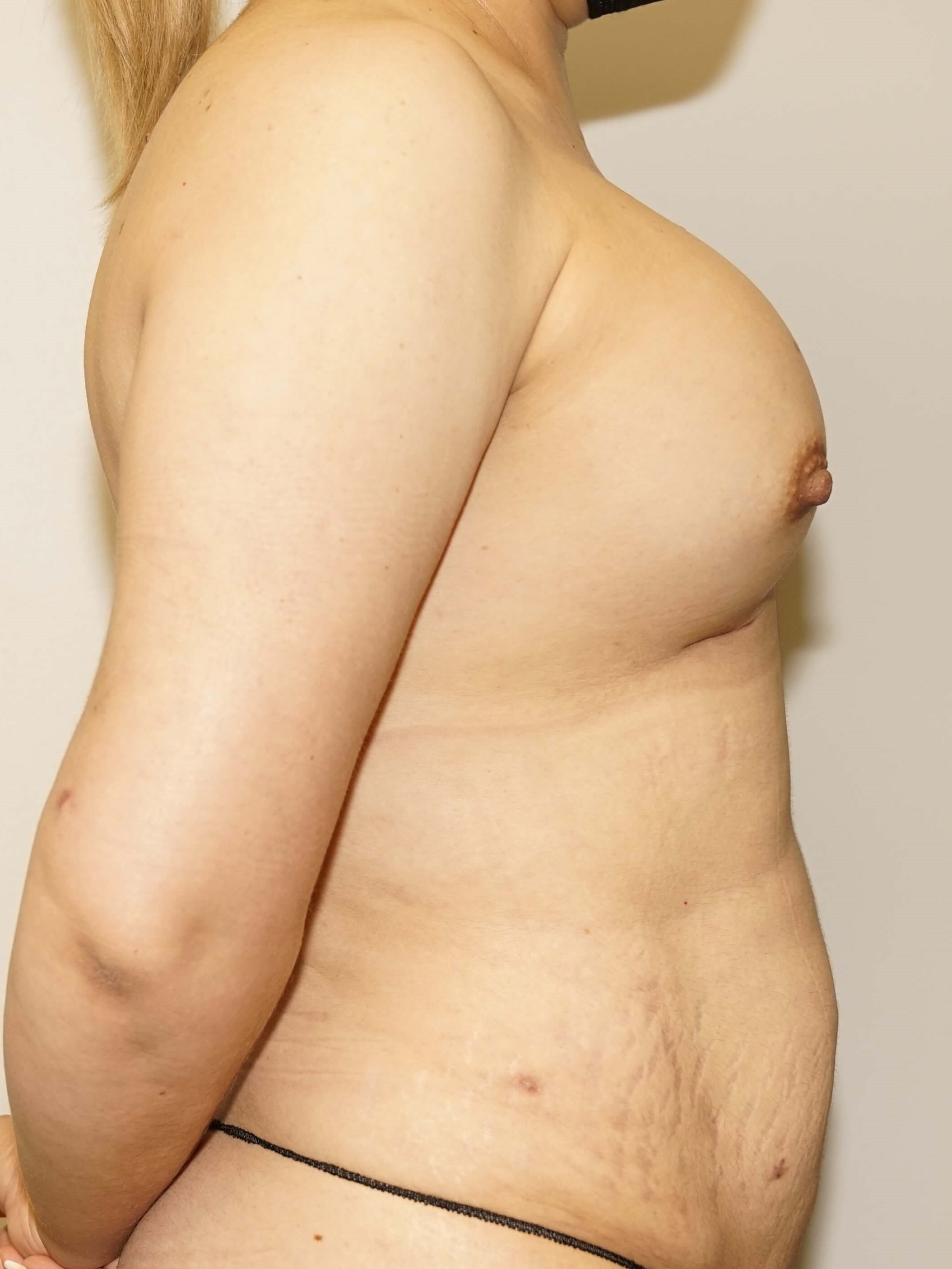 Woman has Mommy Makeover After