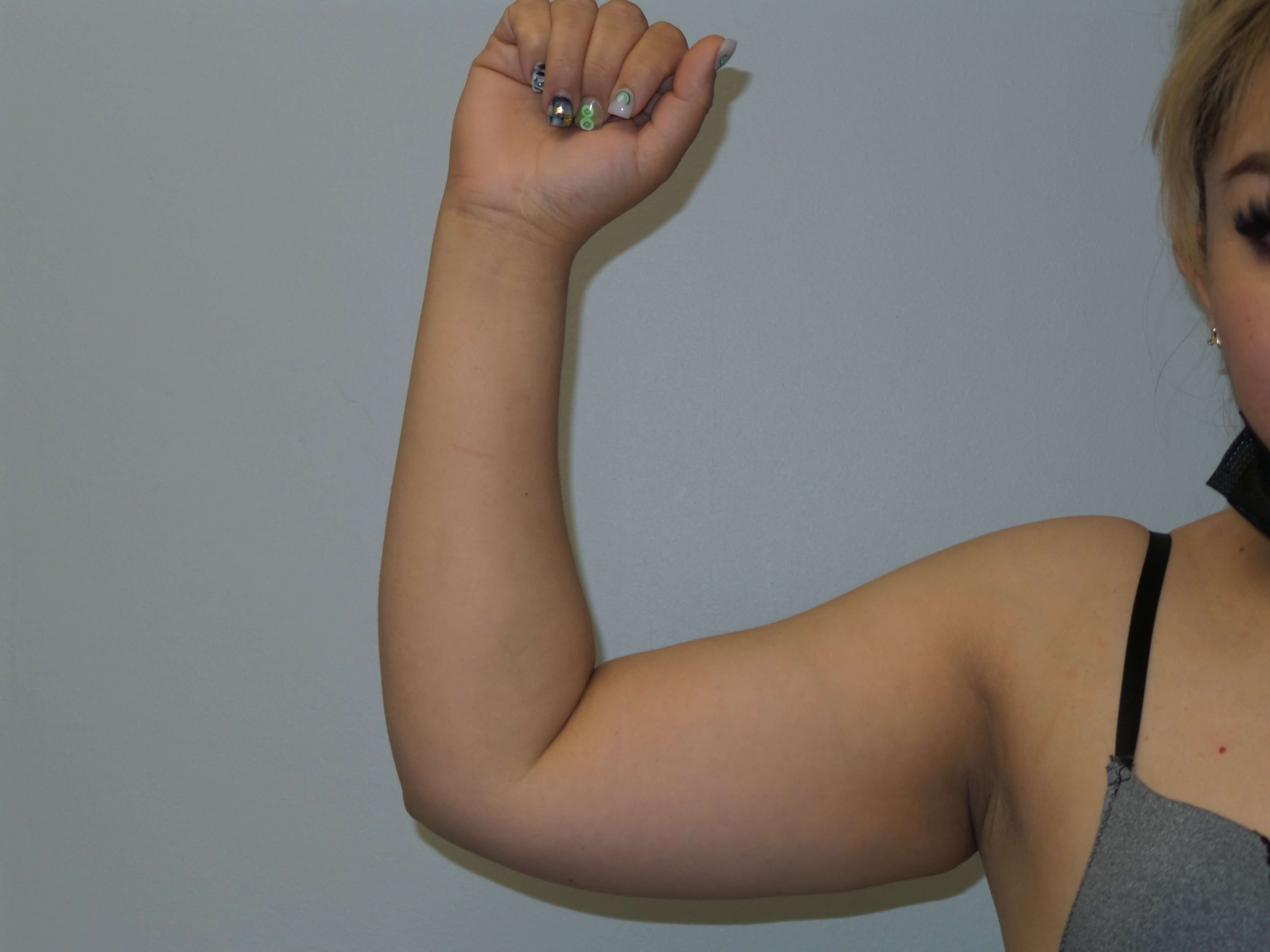 Woman has Mommy Makeover Before