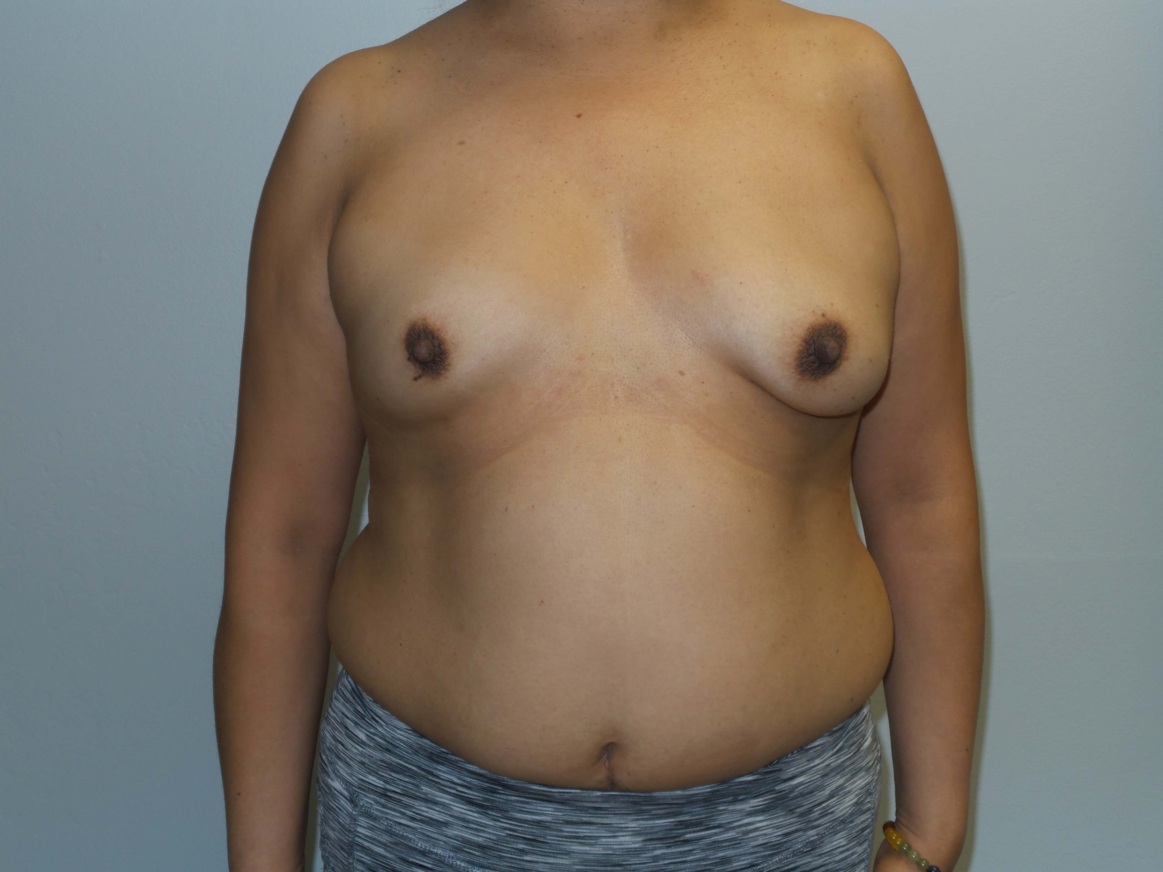 Westlake Woman Has Breast Aug Before