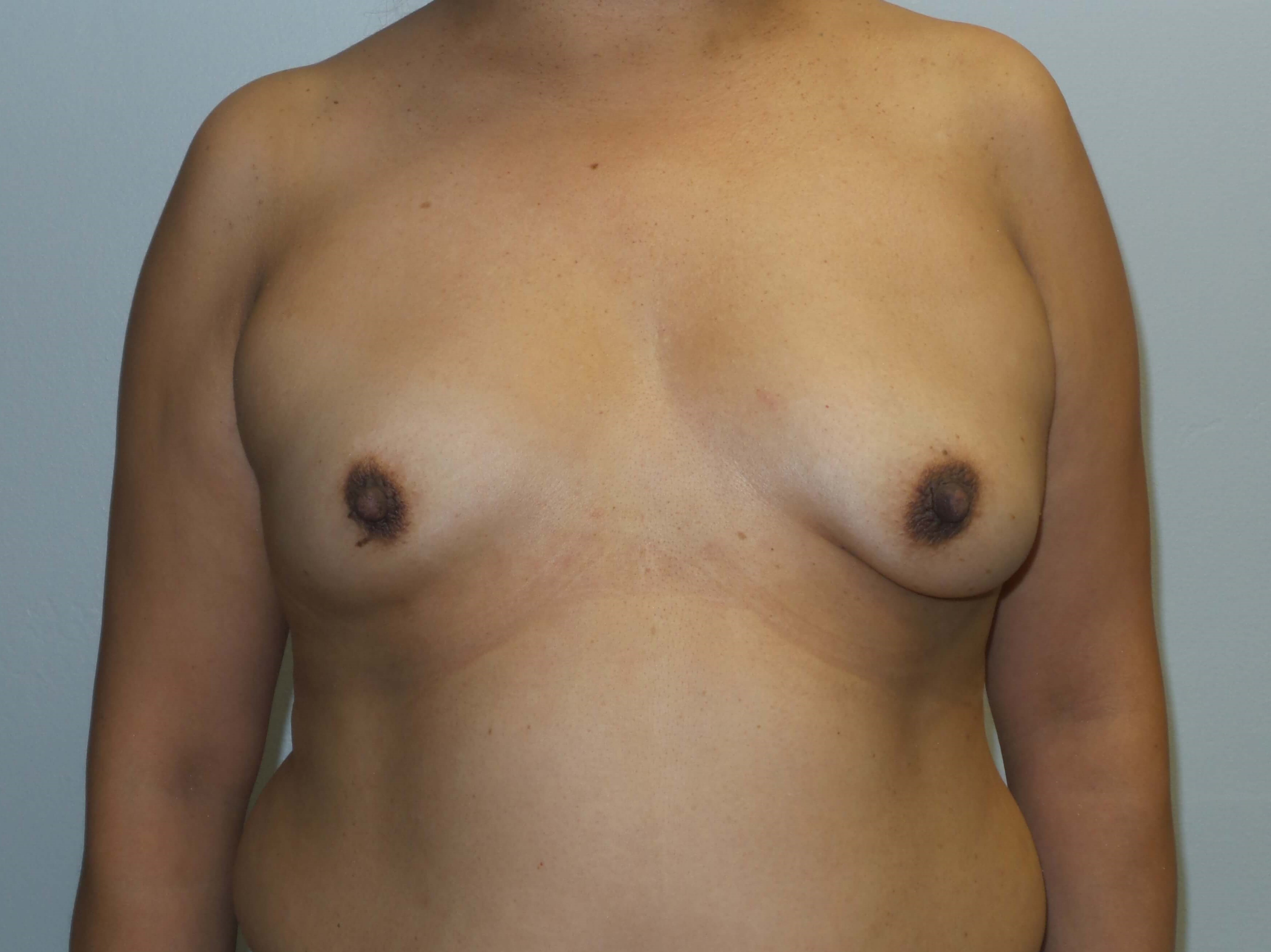 Westlake Woman Has Breast Aug Before