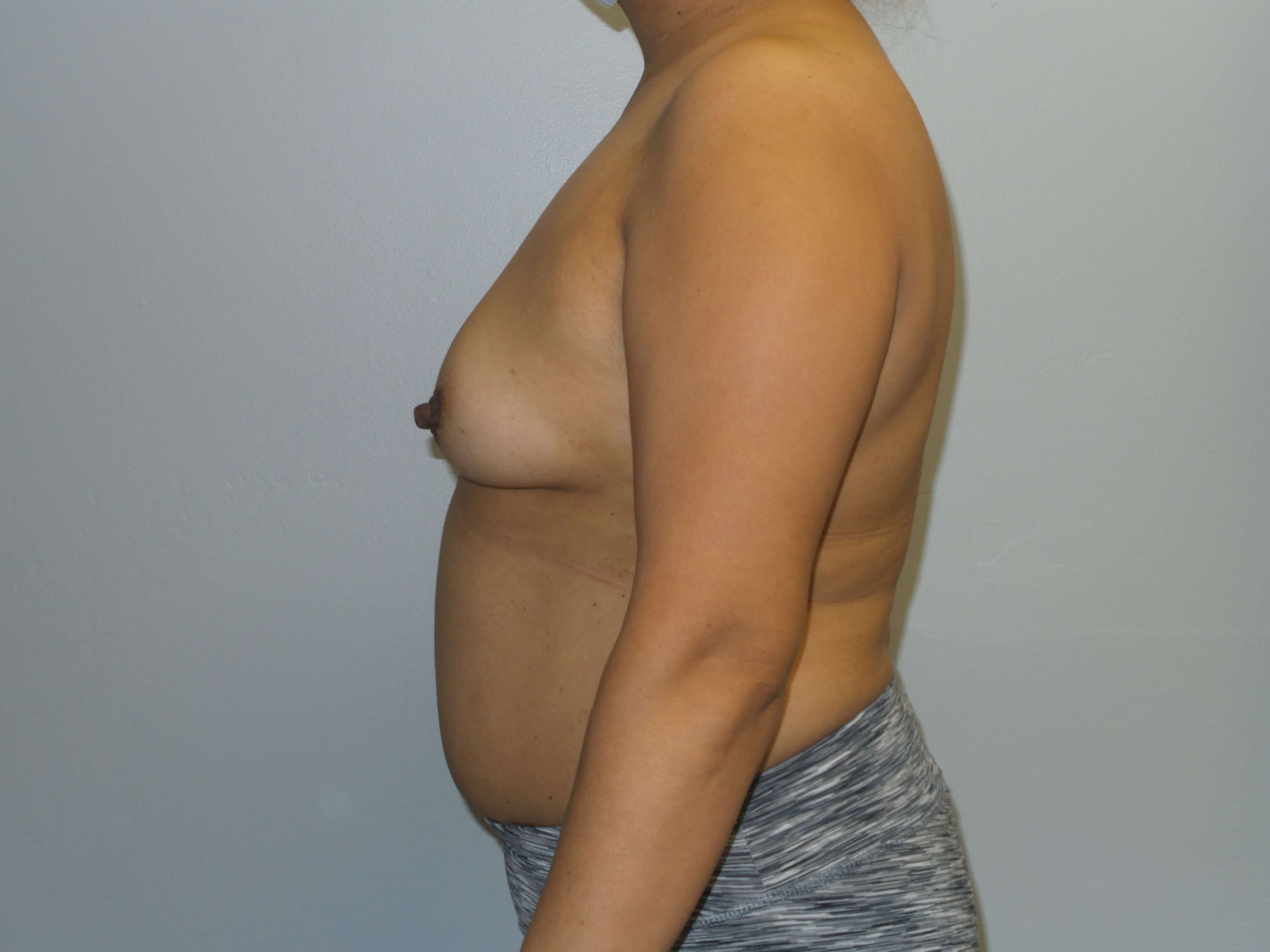 Westlake Woman Has Breast Aug Before