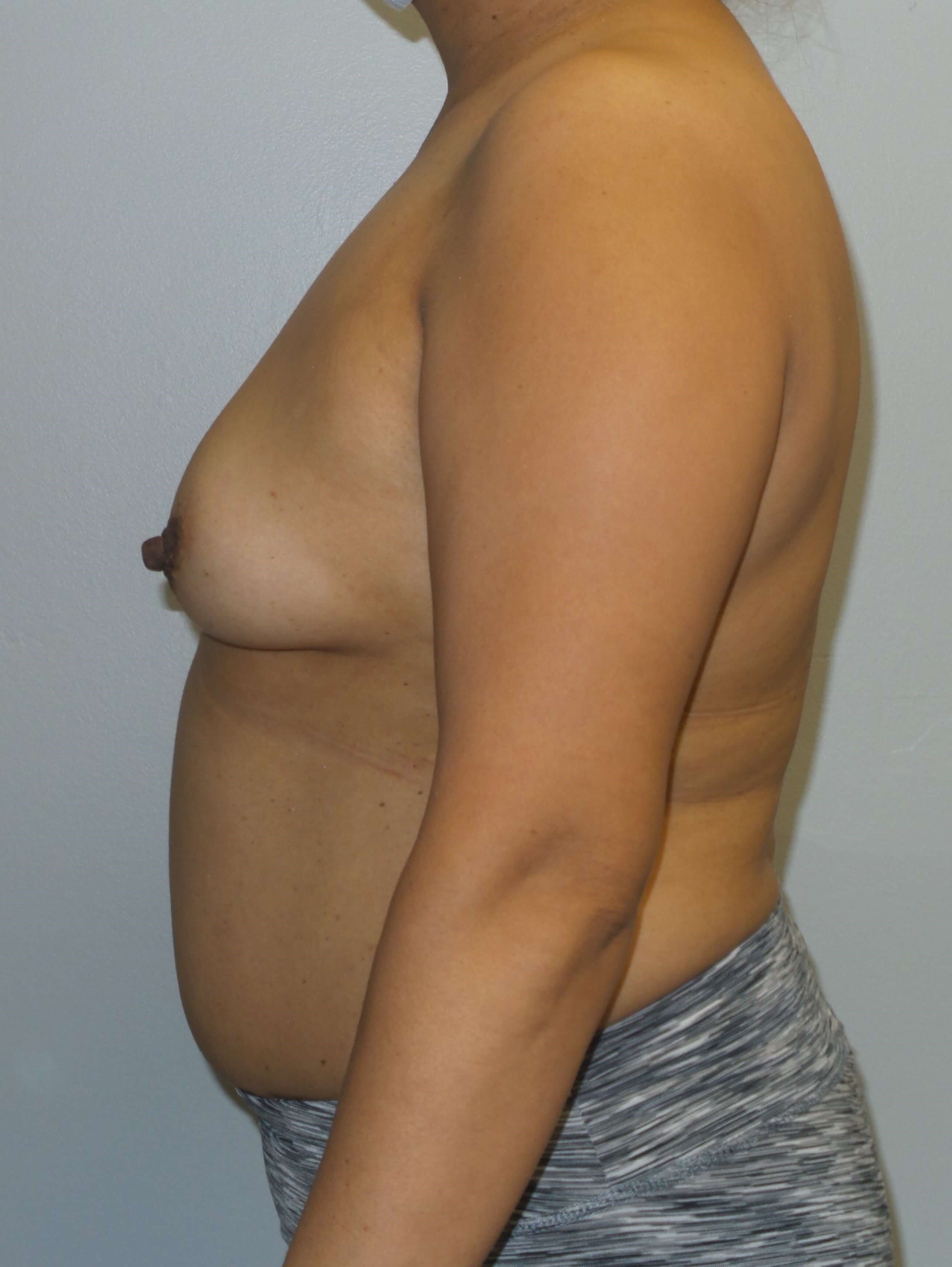 Westlake Woman Has Breast Aug Before
