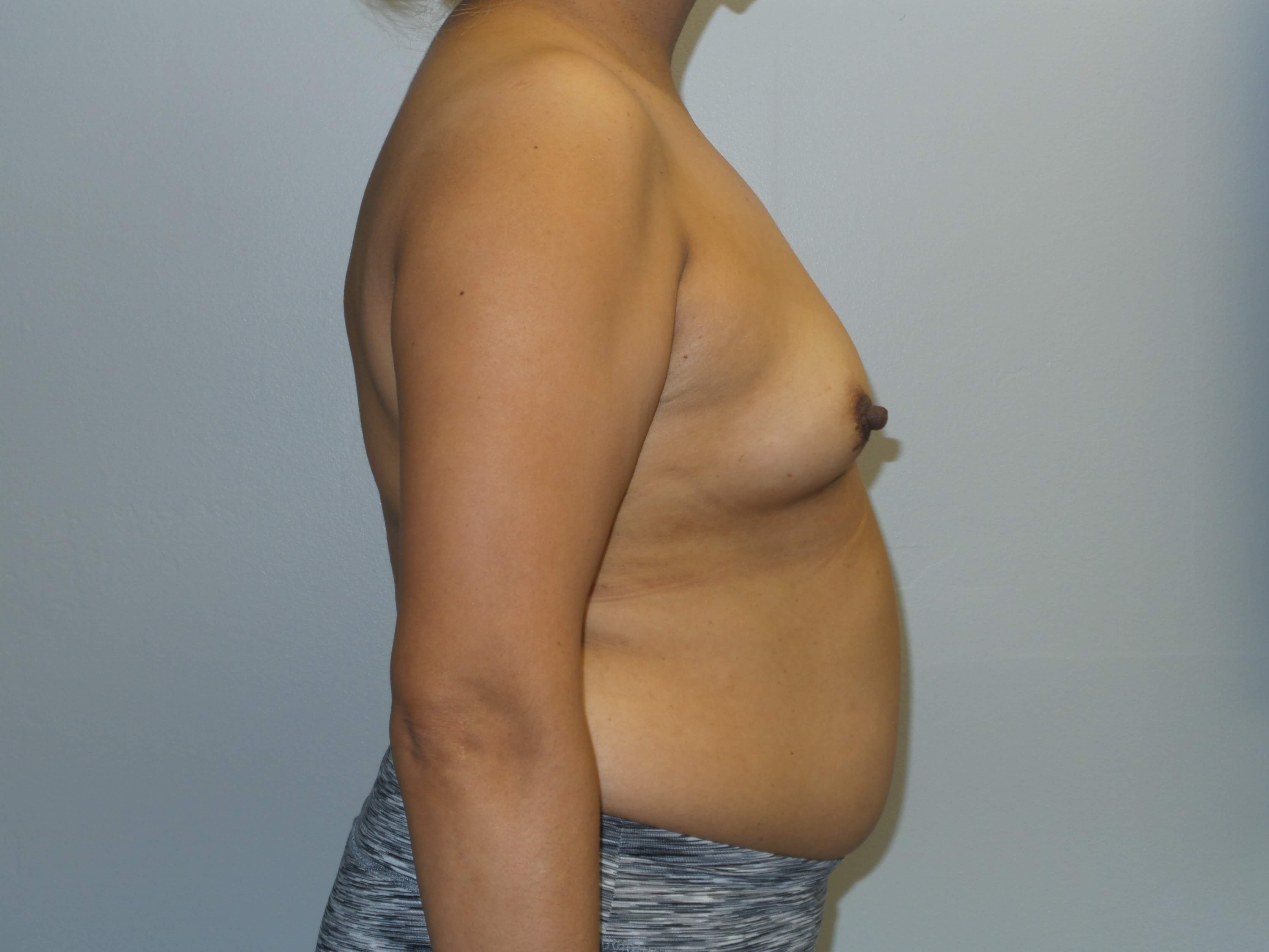 Westlake Woman Has Breast Aug Before