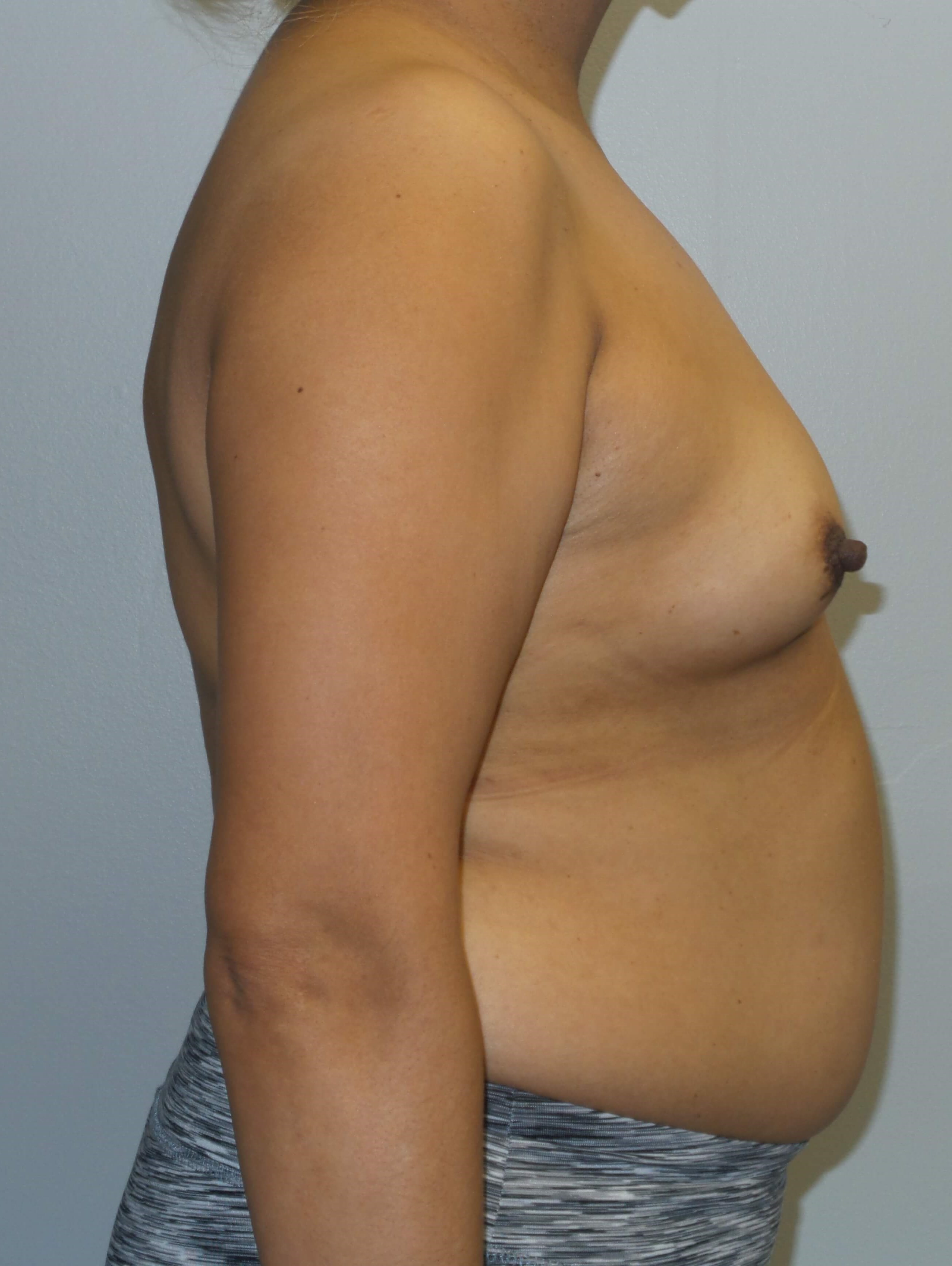 Westlake Woman Has Breast Aug Before