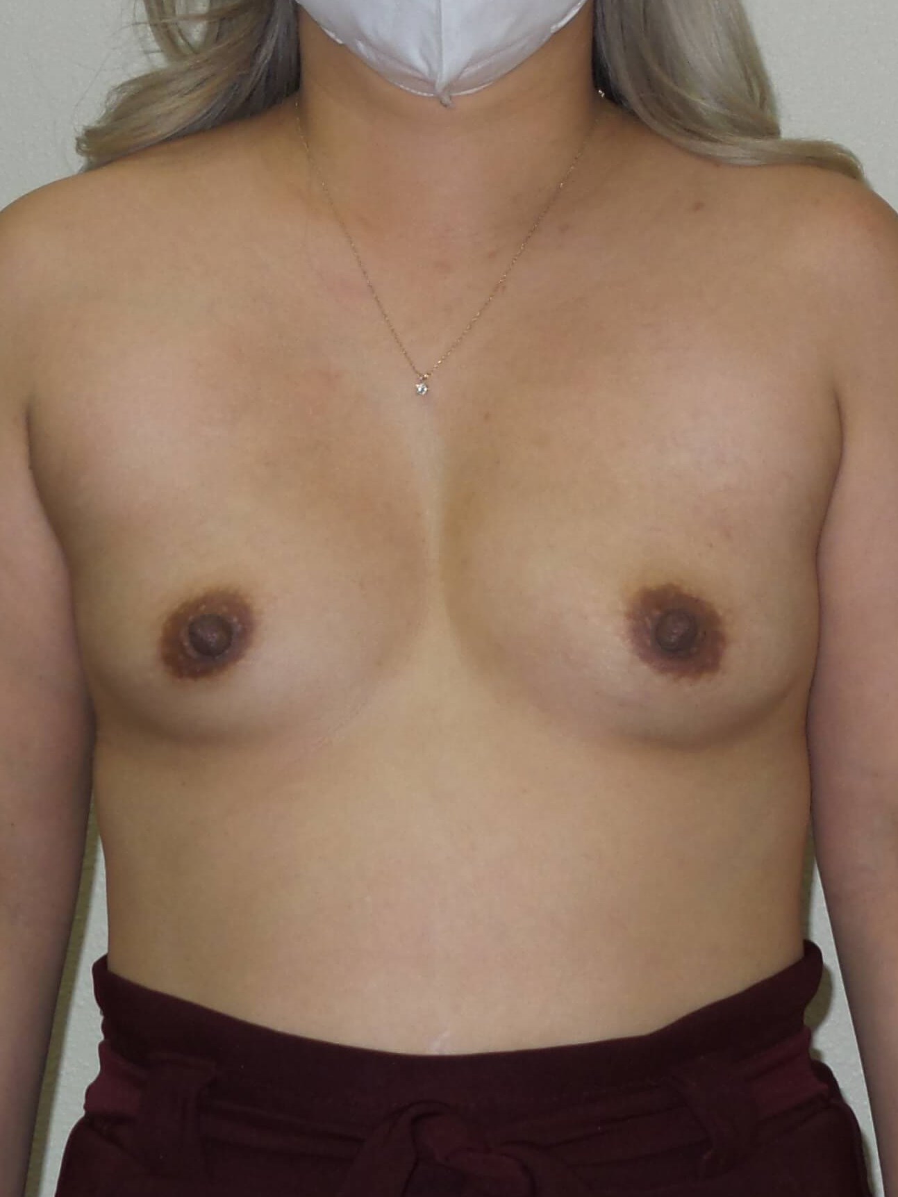 Westlake Woman Has Breast Aug Before