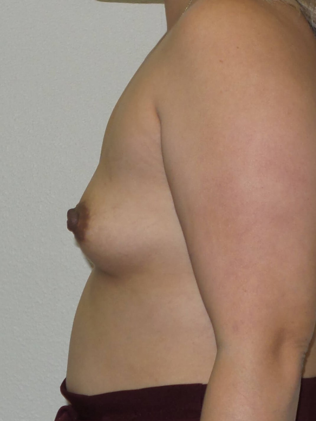 Westlake Woman Has Breast Aug Before