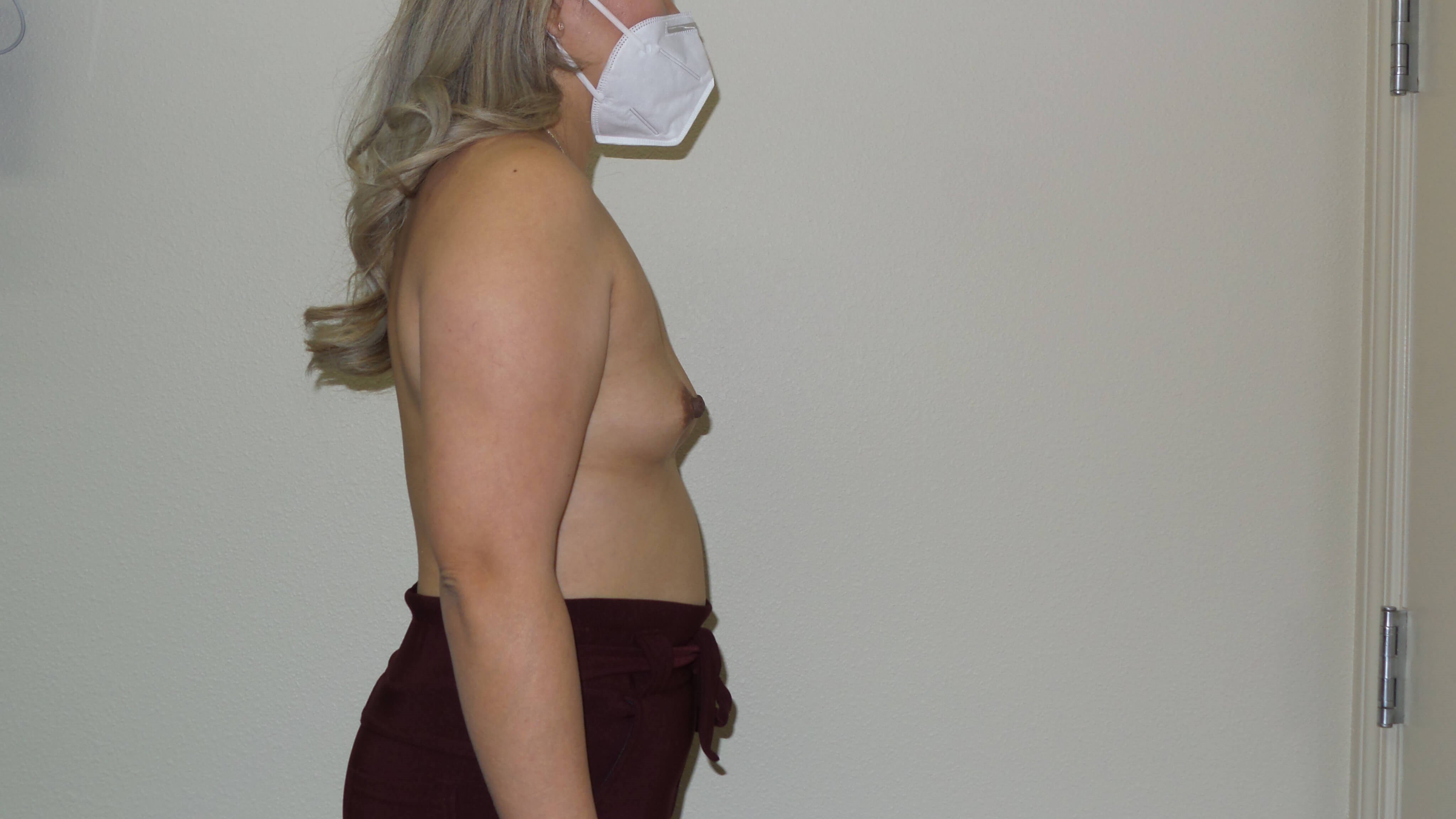 Westlake Woman Has Breast Aug Before