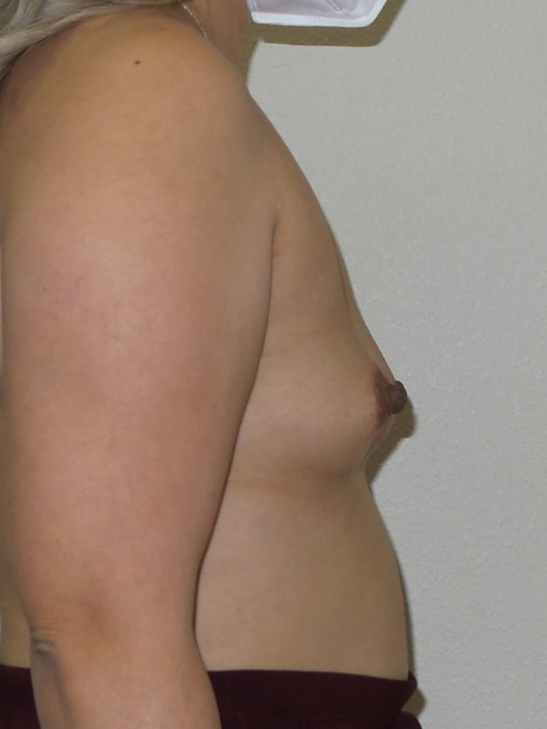 Westlake Woman Has Breast Aug Before
