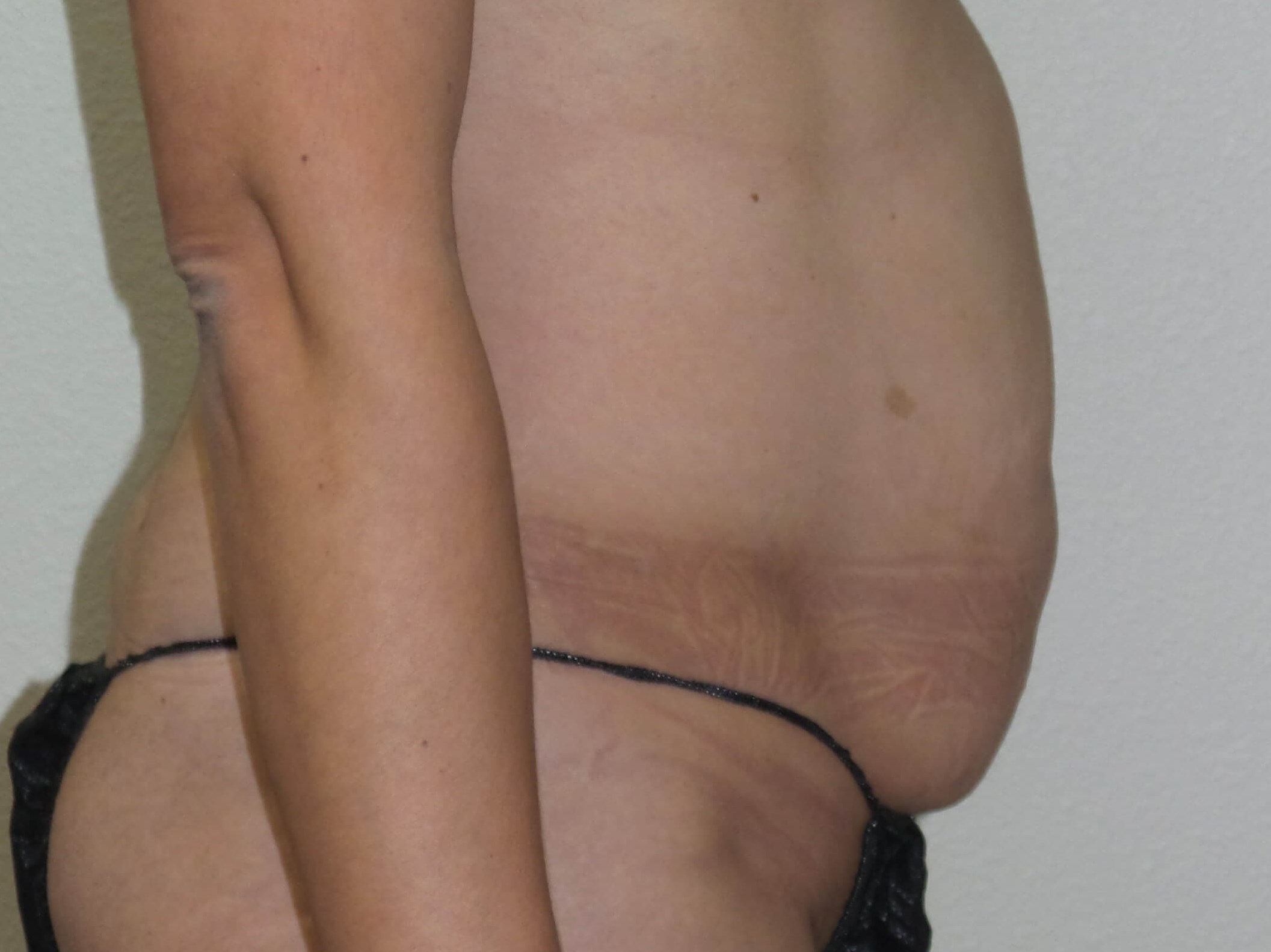 Woman has Mommy Makeover Before